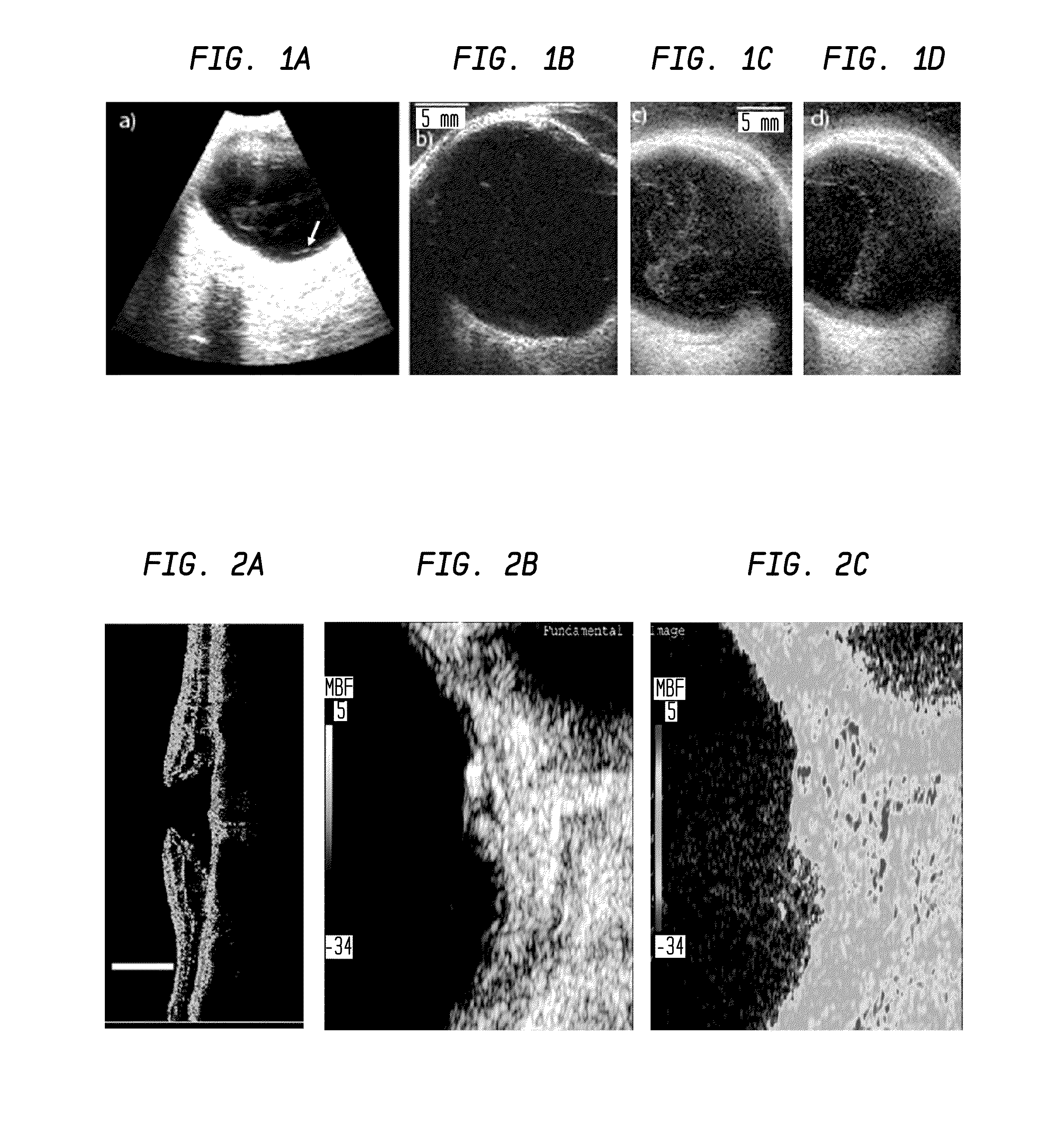 Methods for diagnosing vitreo-retinal disease