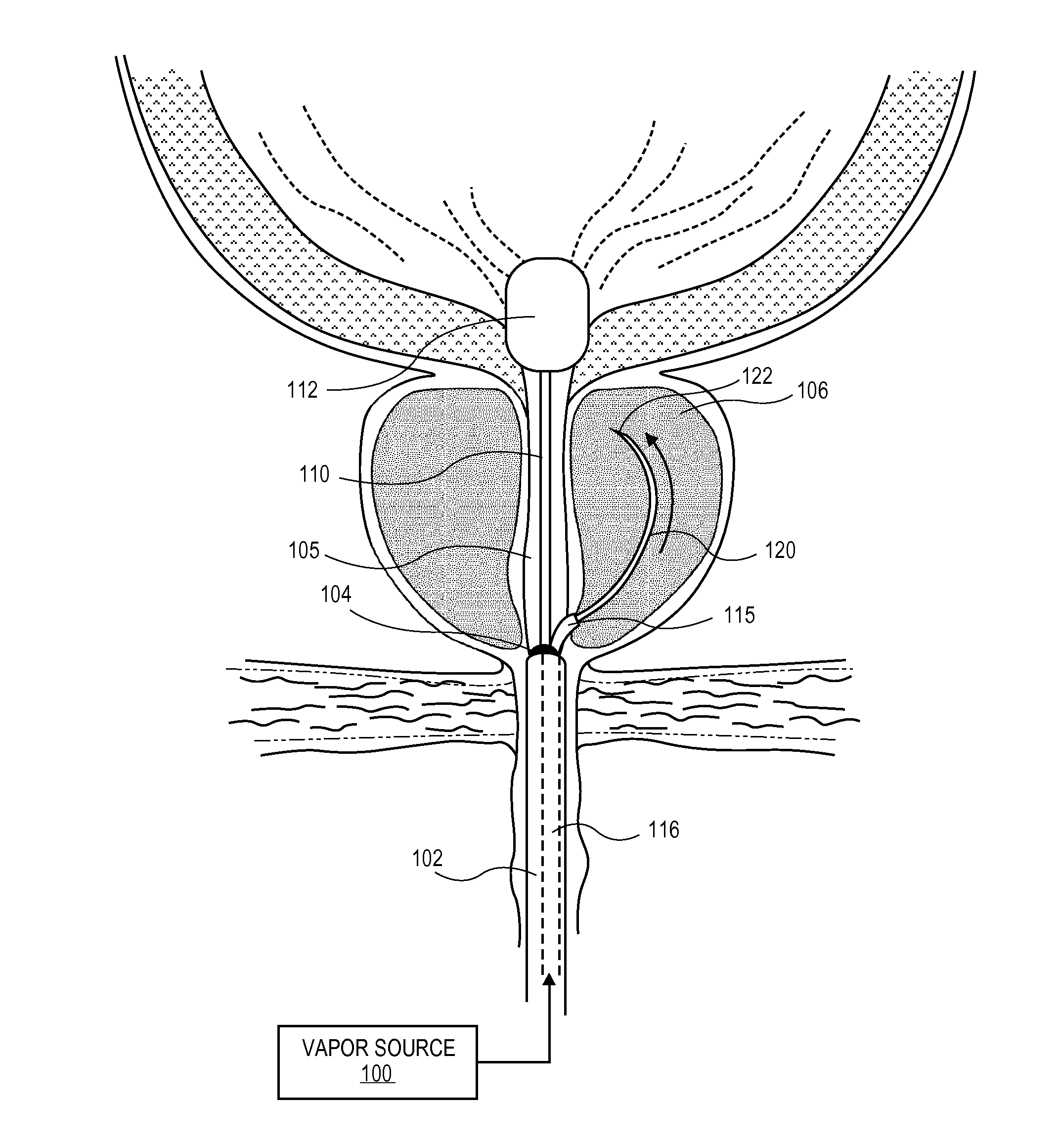 Systems and methods for treatment of prostatic tissue