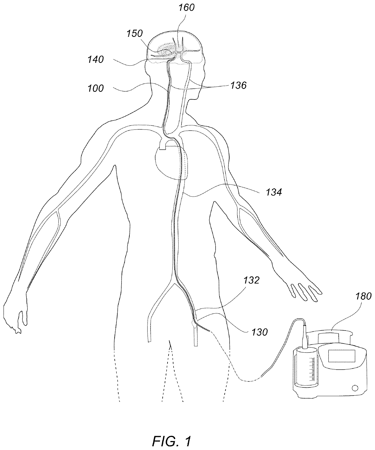 Methods of use of a balloon-tip aspiration catheter for ischemic stroke interventions