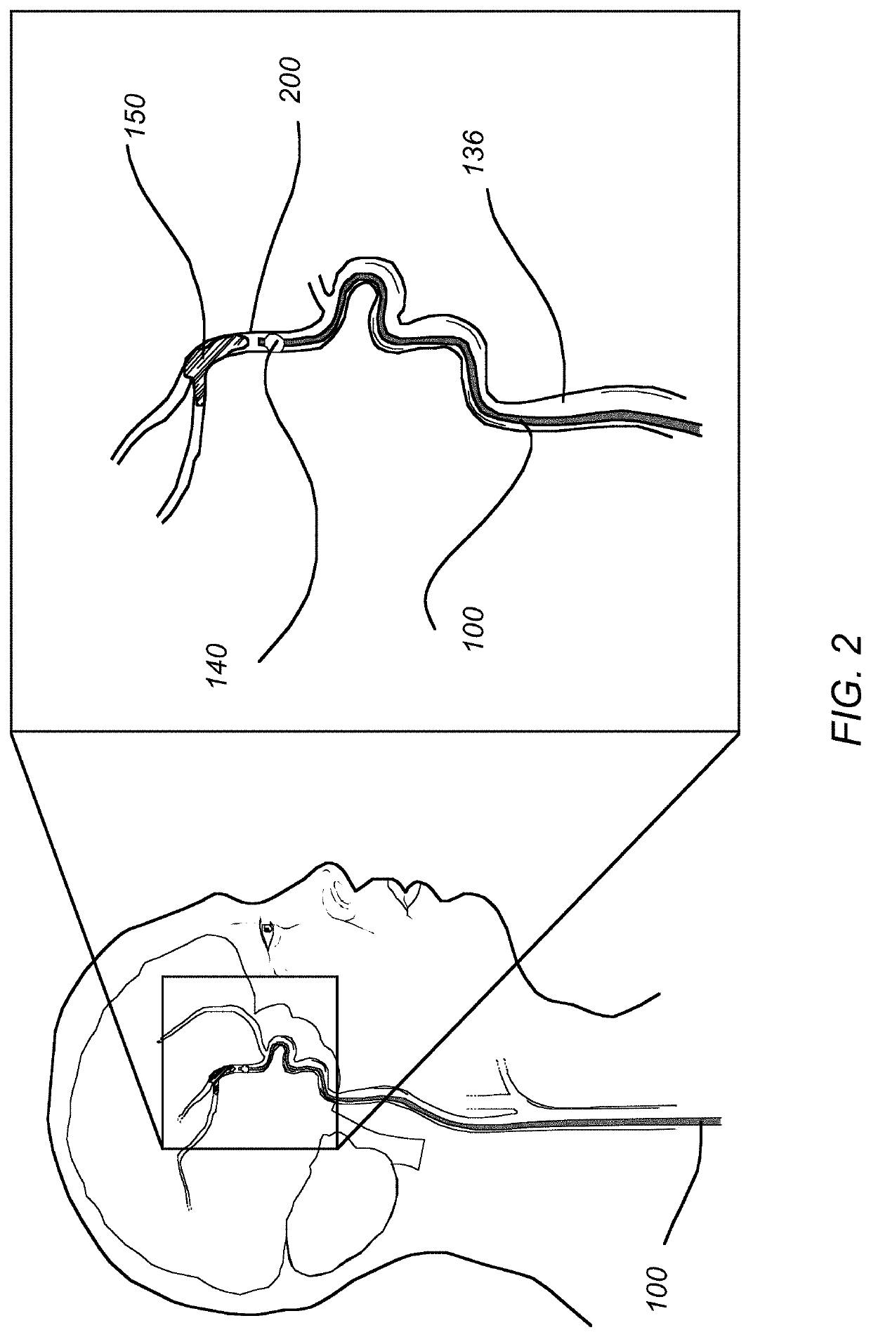 Methods of use of a balloon-tip aspiration catheter for ischemic stroke interventions