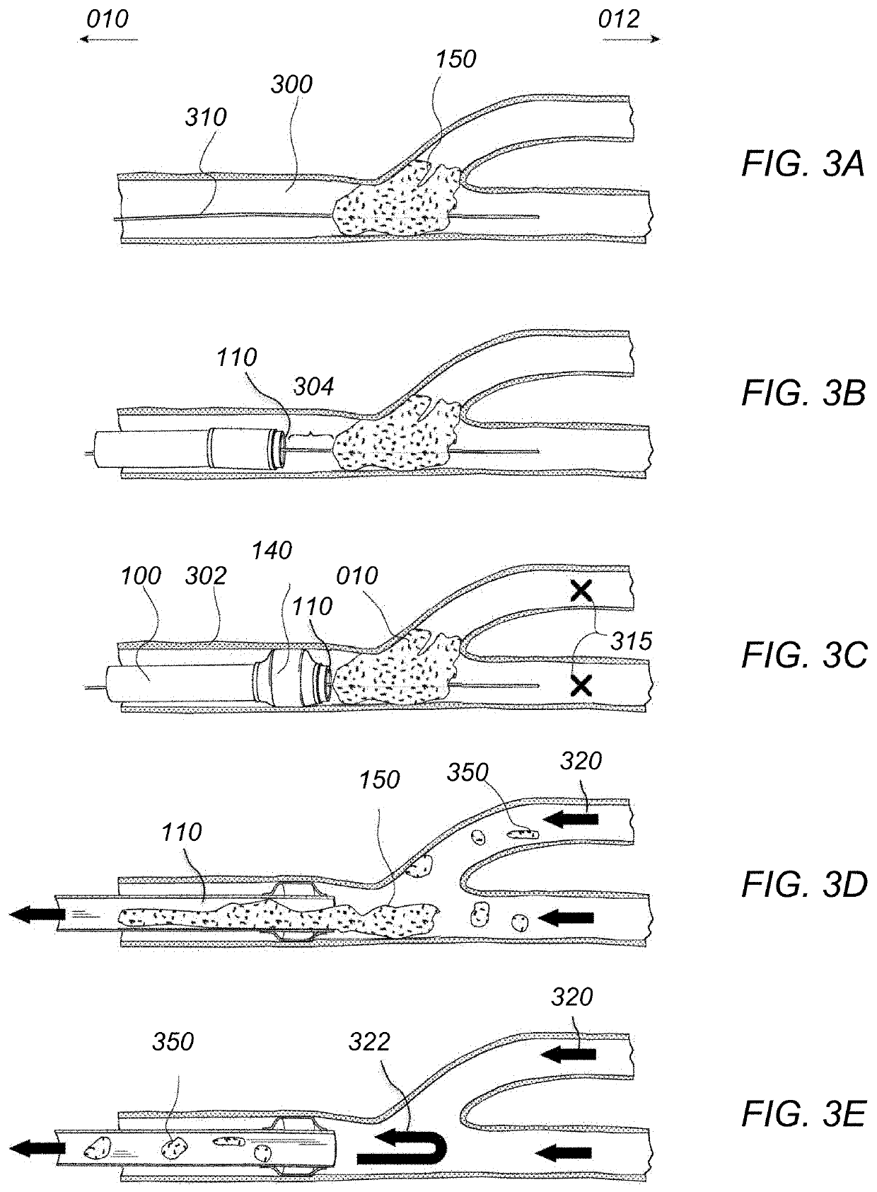 Methods of use of a balloon-tip aspiration catheter for ischemic stroke interventions