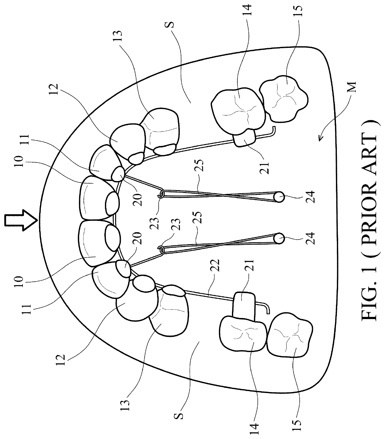 Removable orthodontic correction device