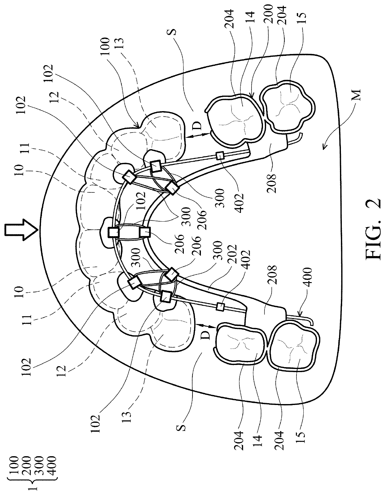 Removable orthodontic correction device