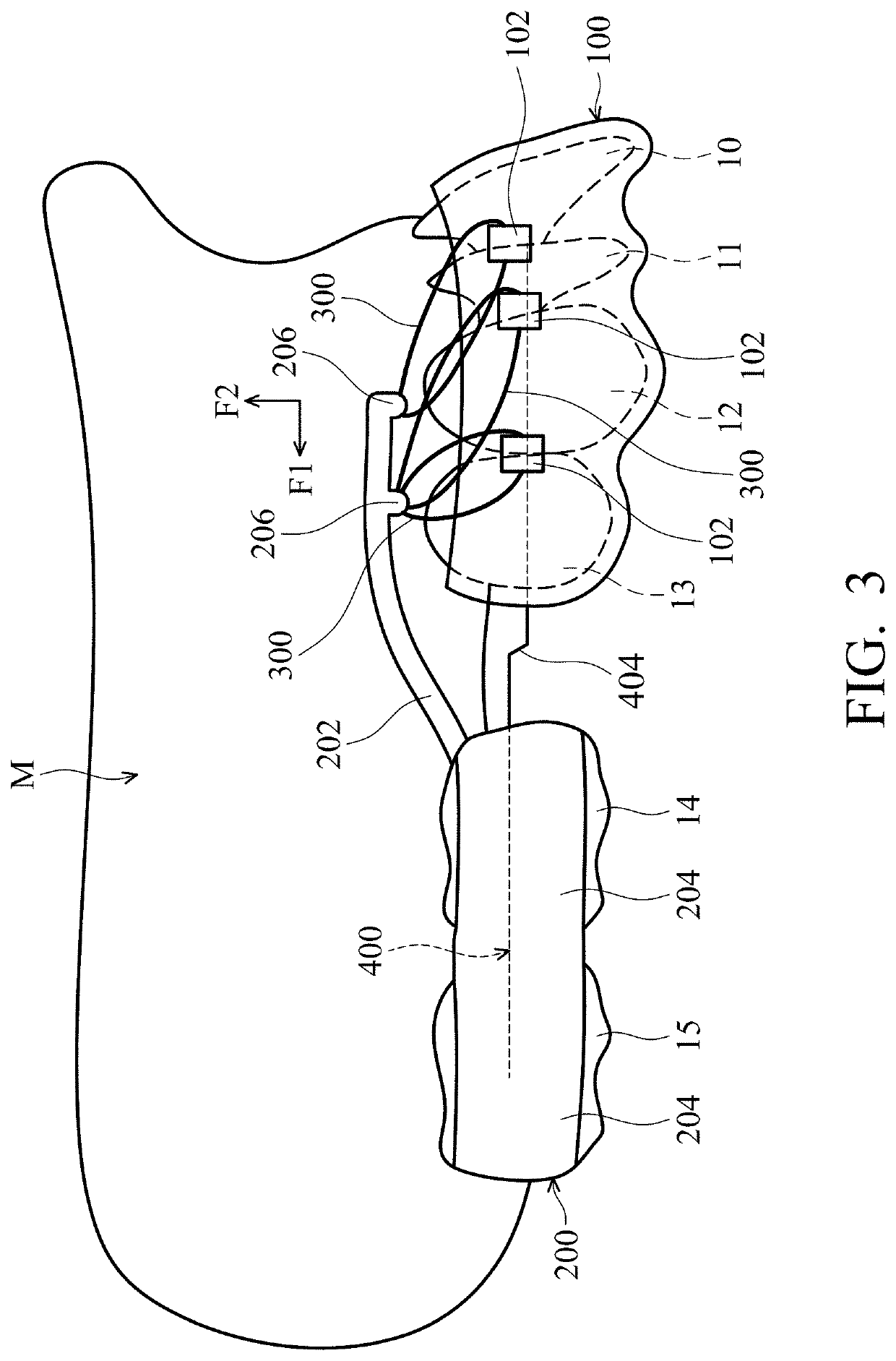 Removable orthodontic correction device