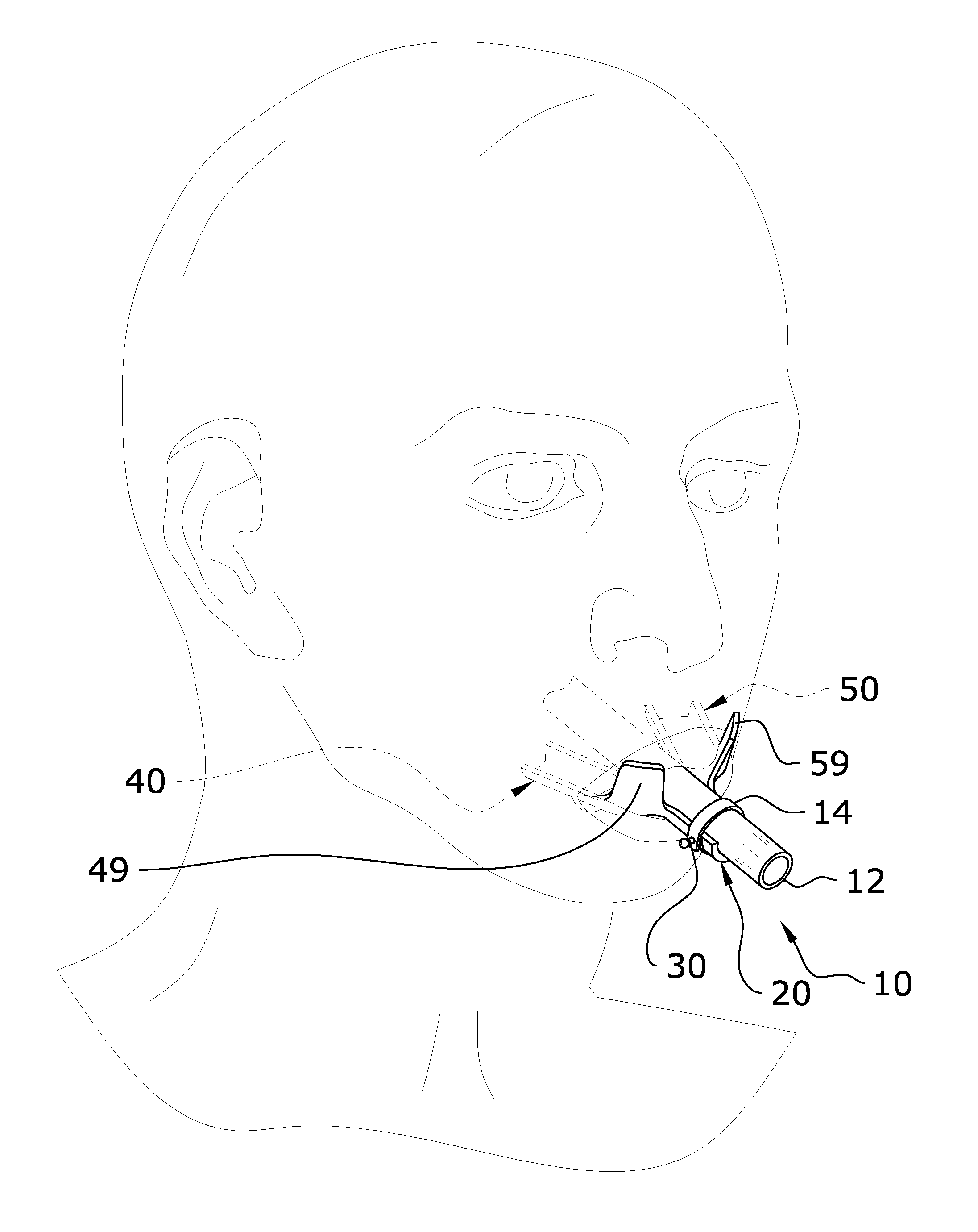 Intubation Tube Oral Appliance System