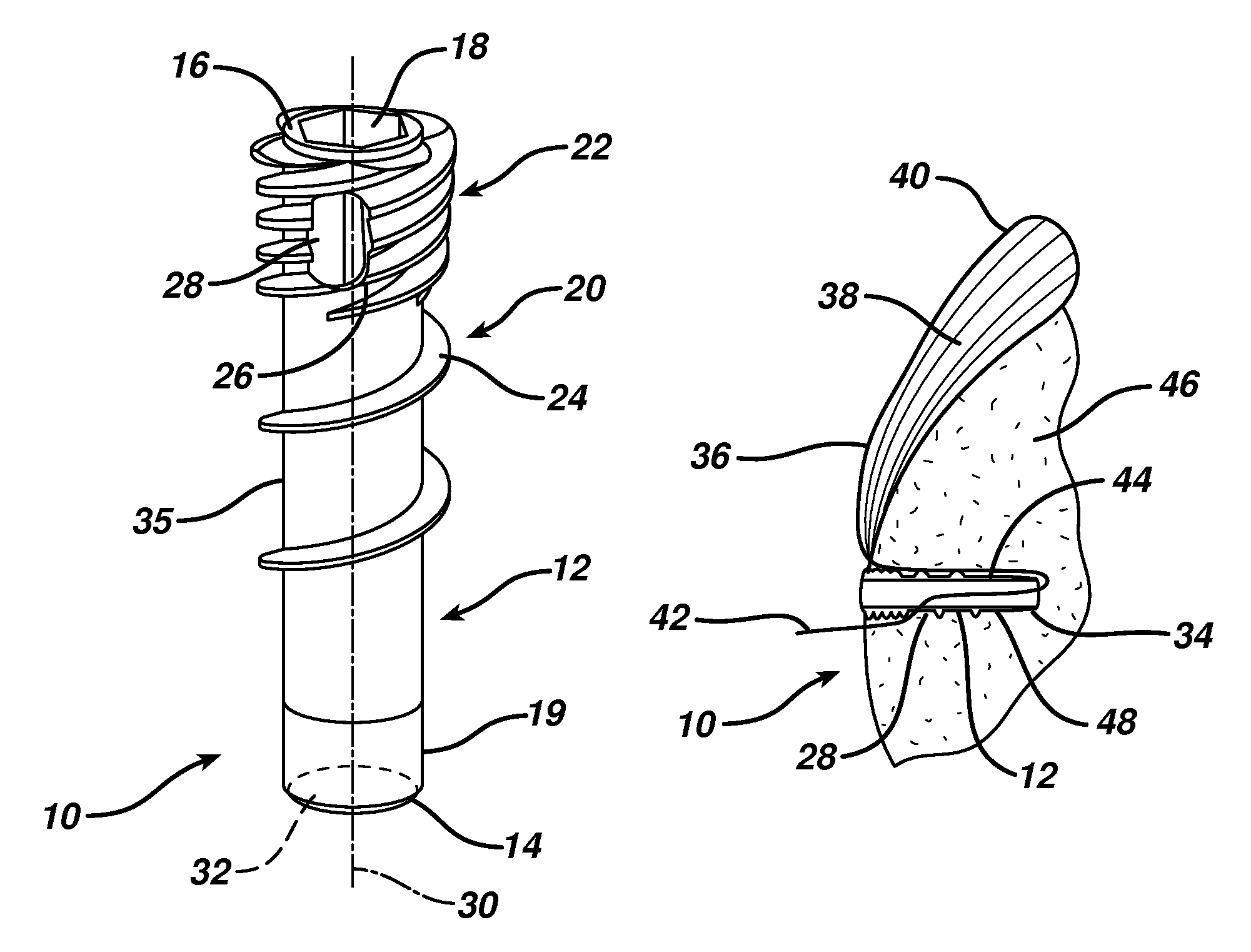 Knotless suture anchor