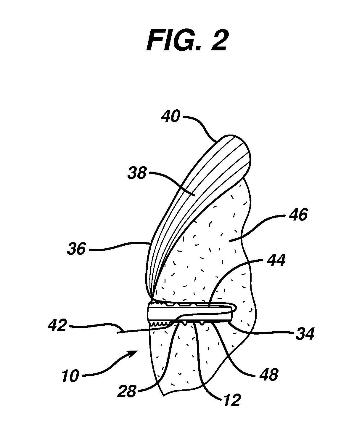 Knotless suture anchor