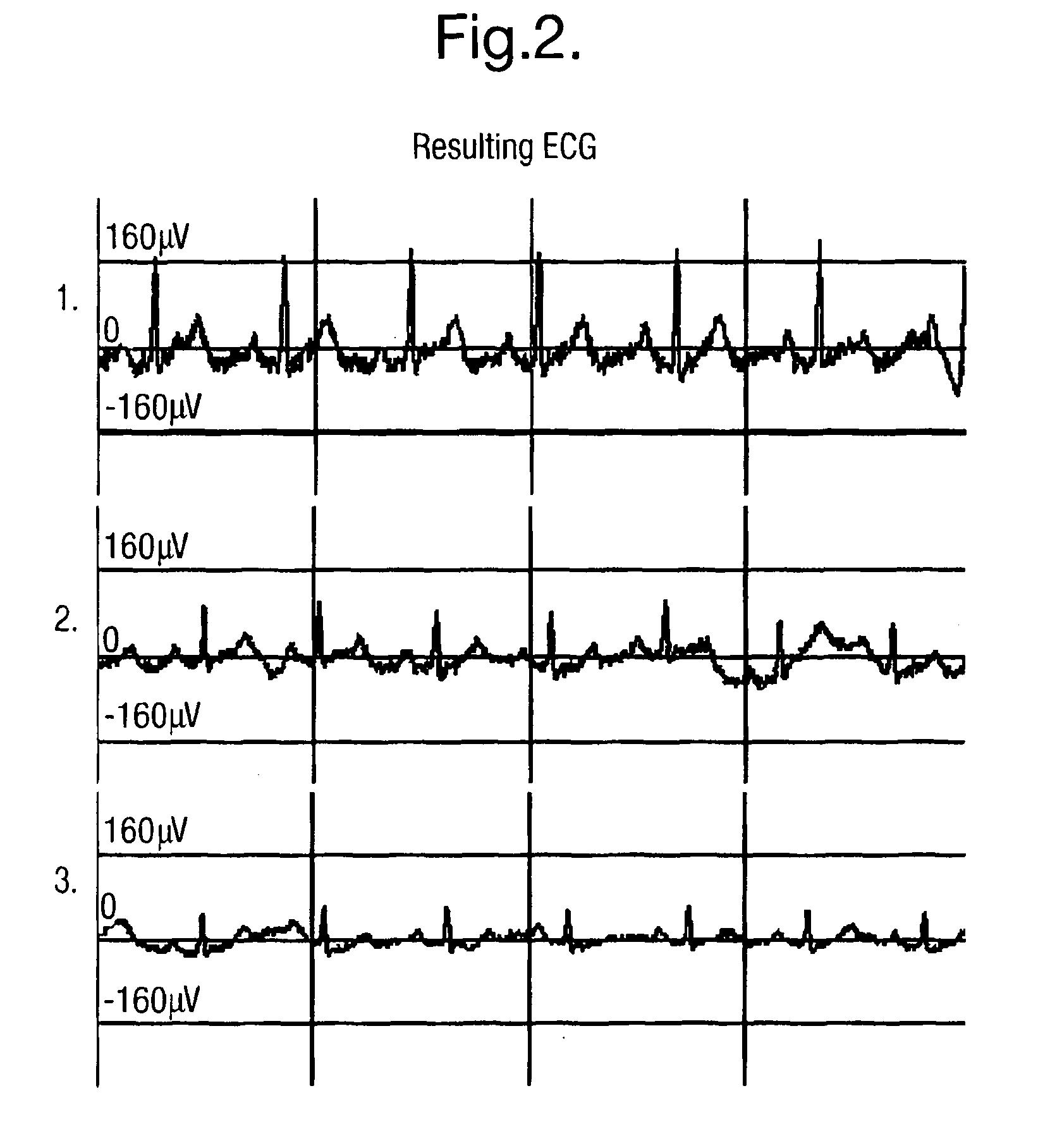 Fetal electrode assembly and fetal electrode