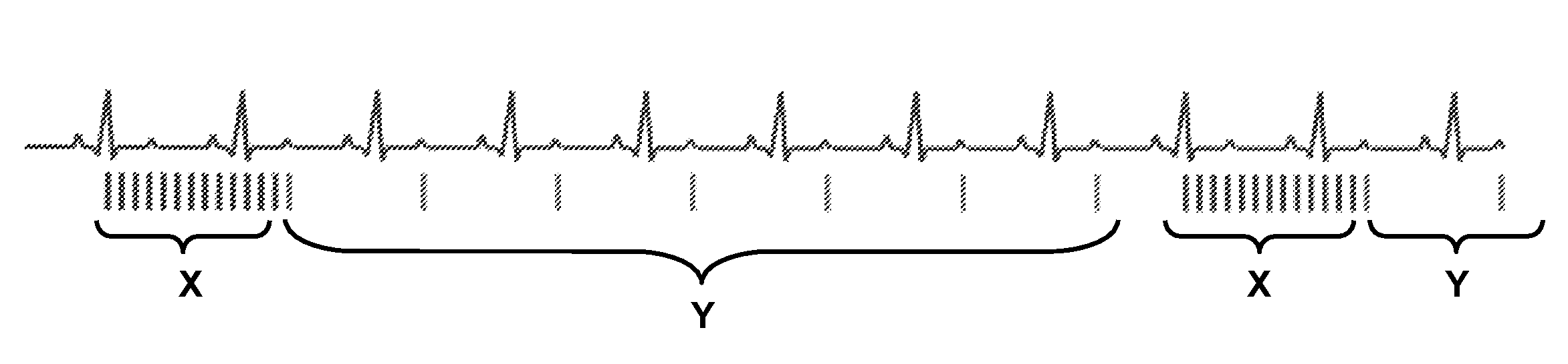 Ultrasound triggering method to reduce cardiac arrhythmia