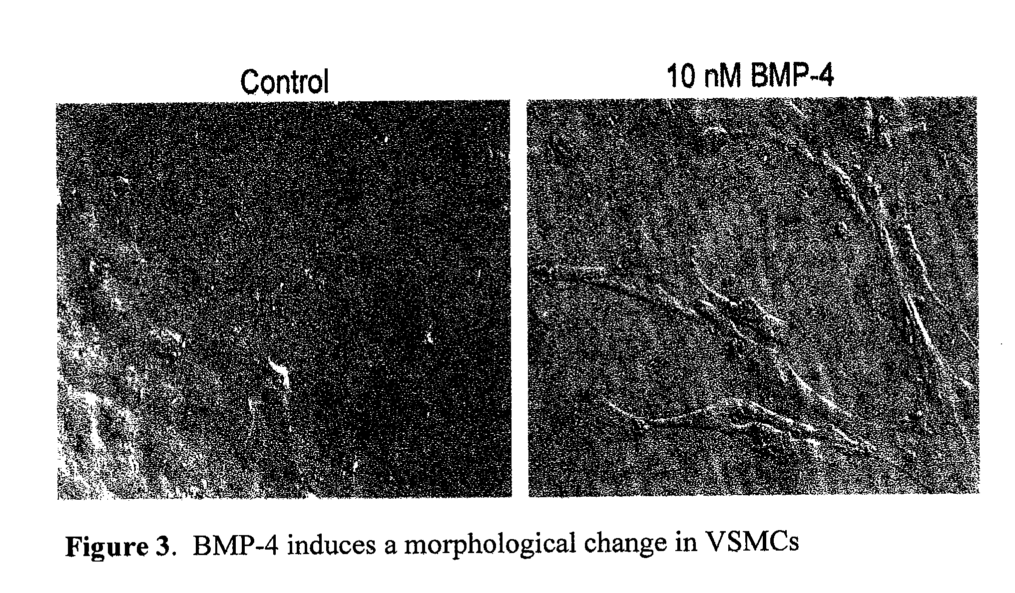 Detection of chronic kidney disease patients or coronary artery disease using bone morphogenic protein-4