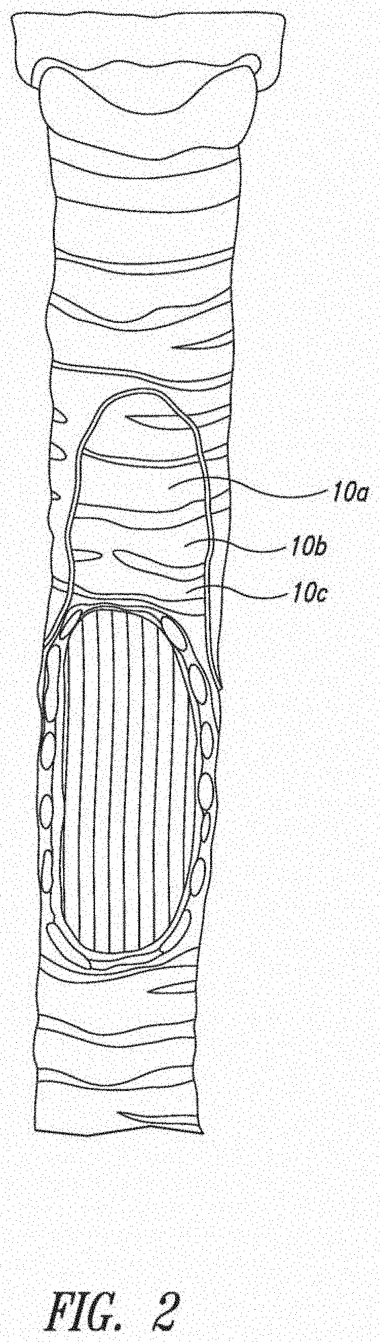 System and method for pulmonary treatment