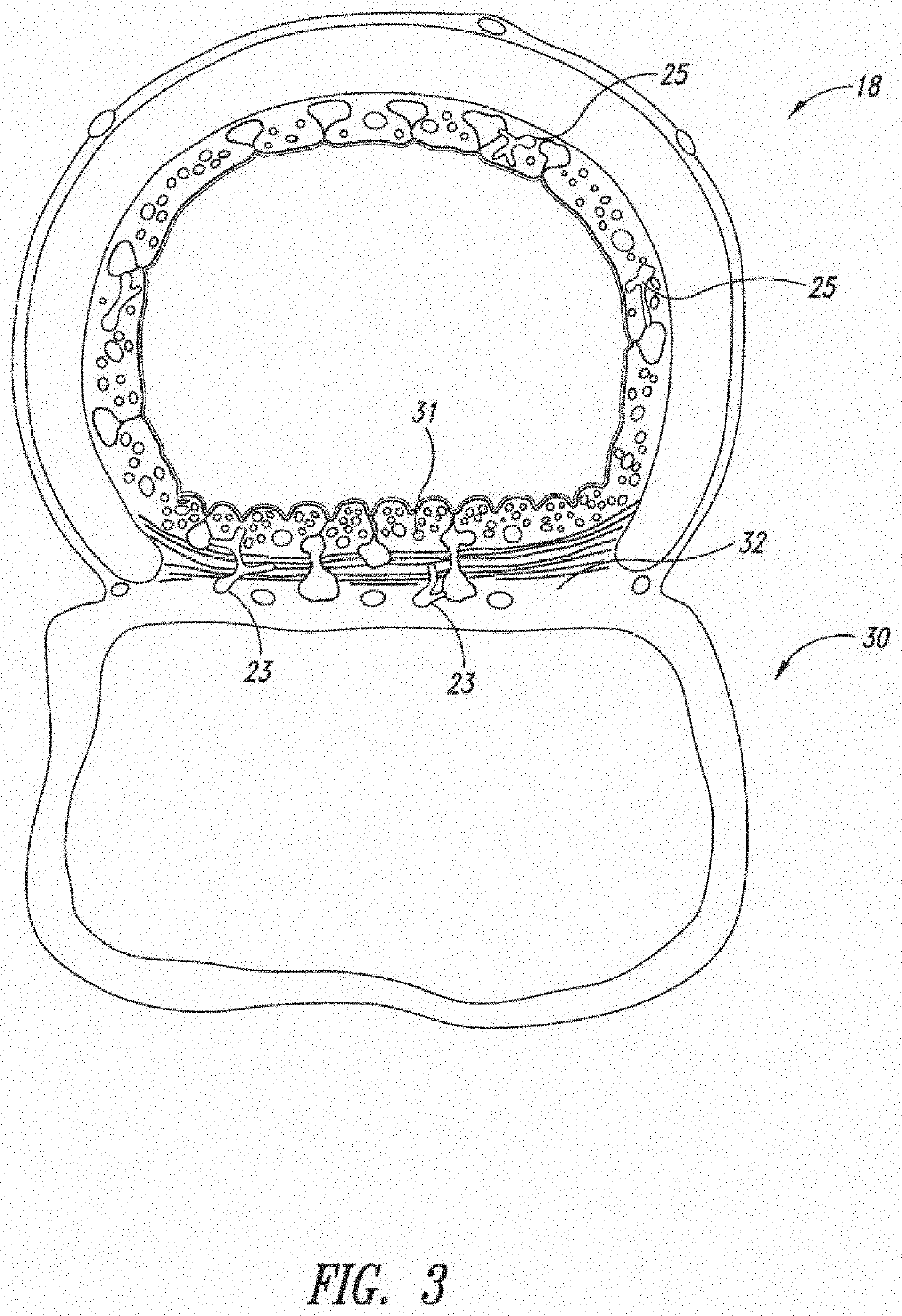 System and method for pulmonary treatment