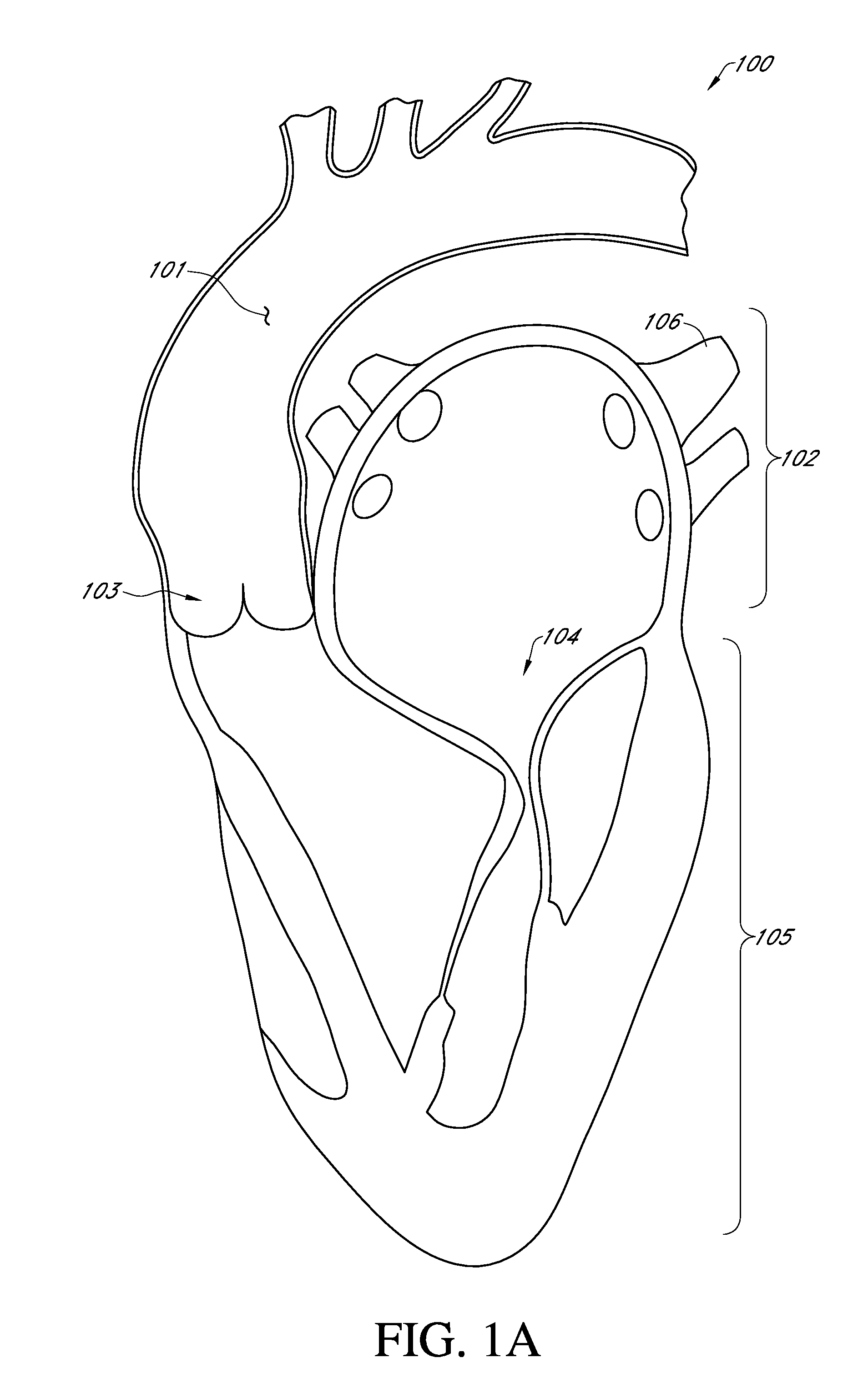 Adjustable endolumenal implant for reshaping the mitral valve annulus