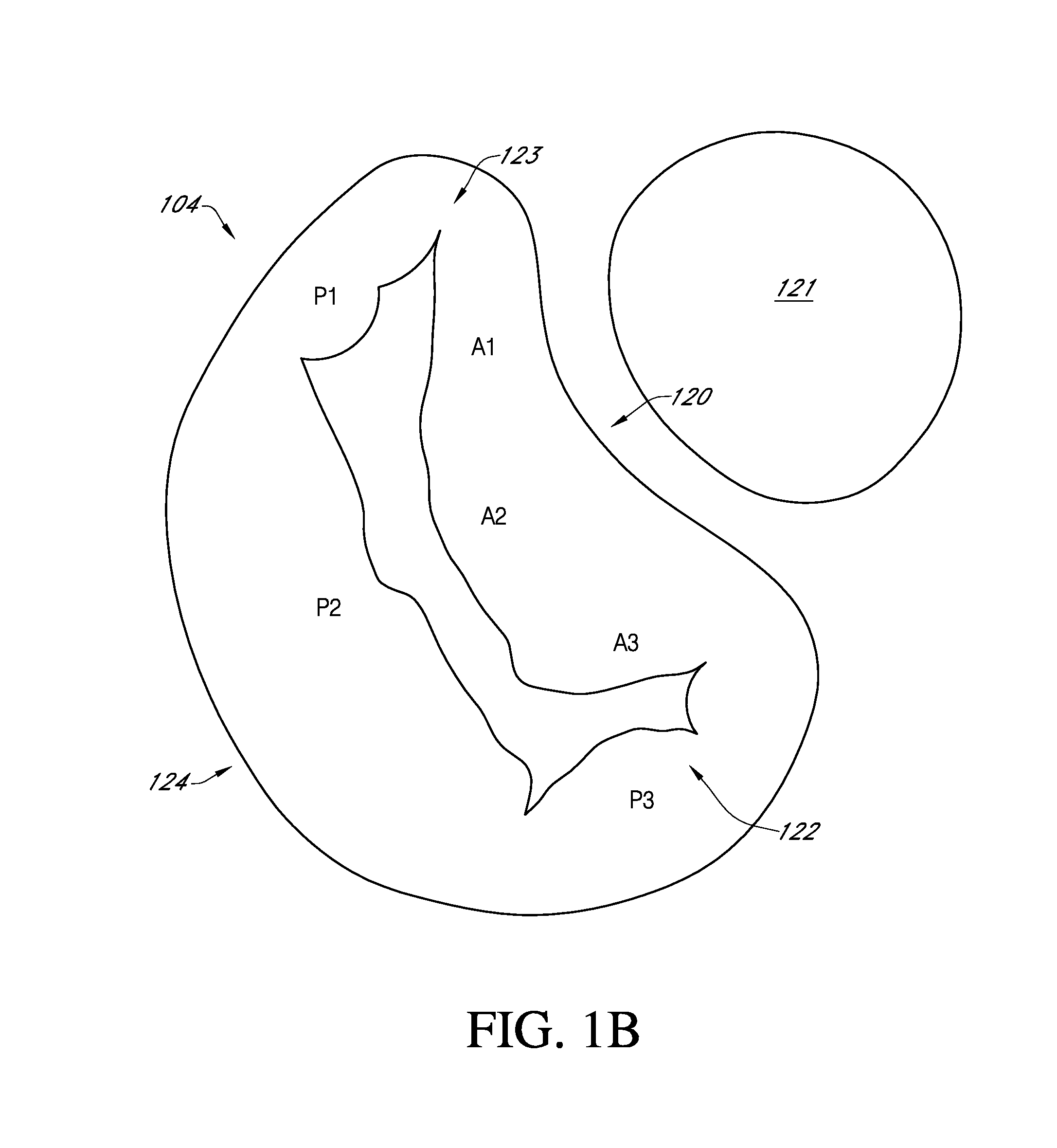 Adjustable endolumenal implant for reshaping the mitral valve annulus