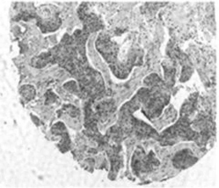 Tumor necrosis factor-alpha induced protein 8 L3 (TIPE3) immunohistochemistry detection kit for diagnosing lung cancer