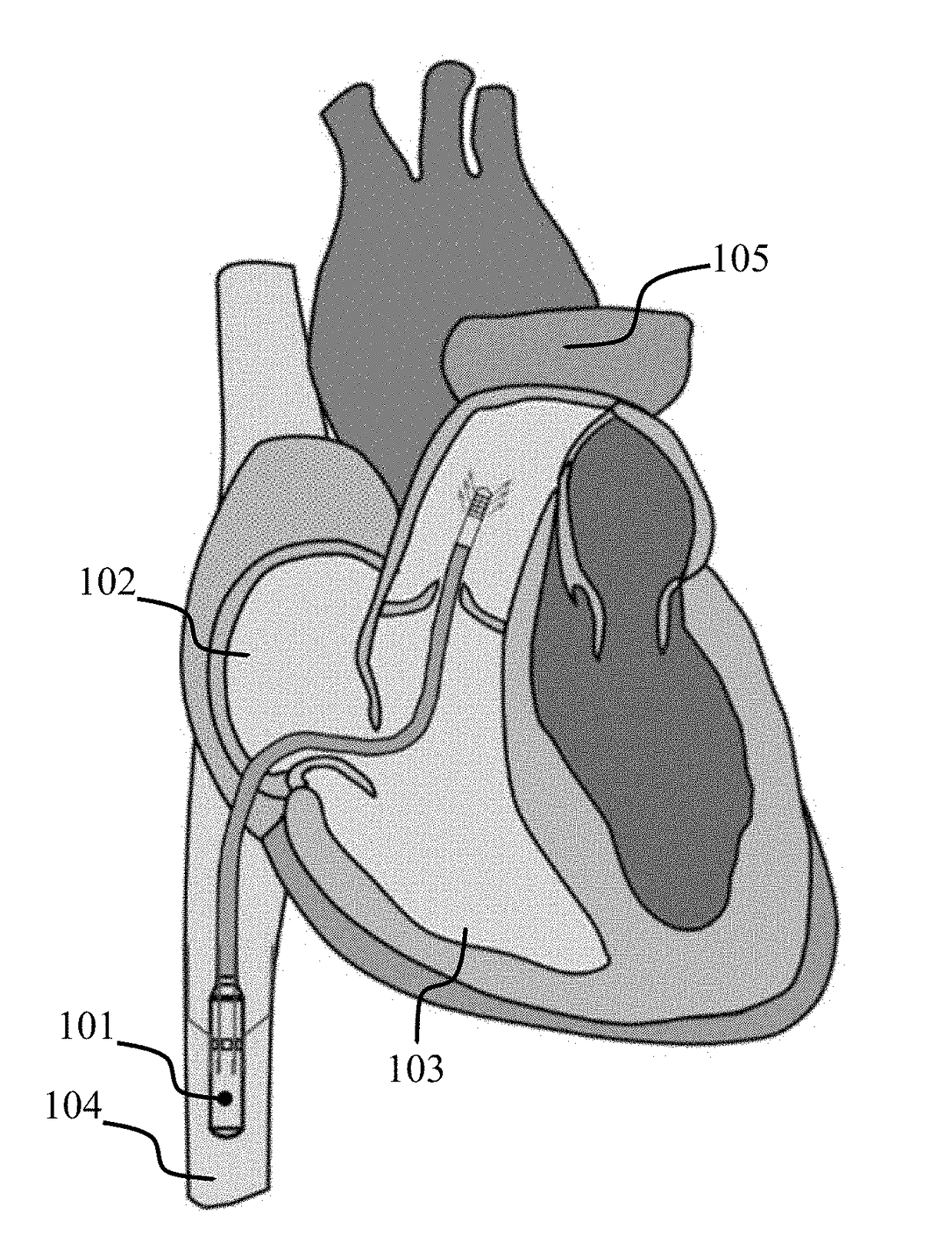 Cavo-arterial pump