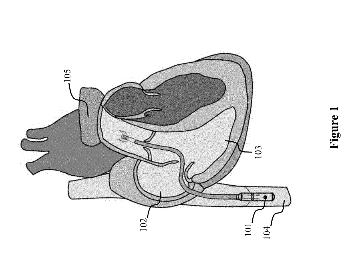 Cavo-arterial pump