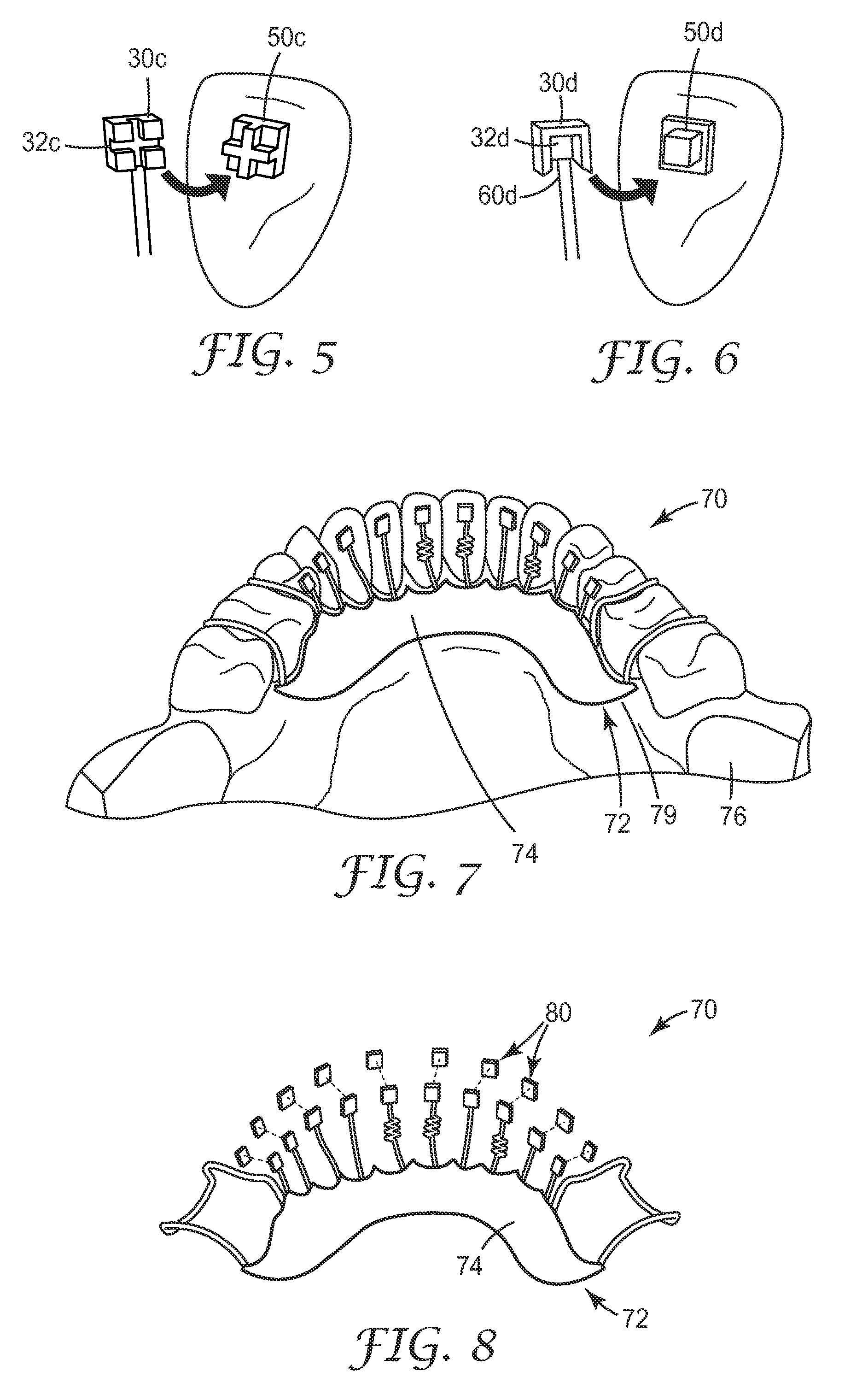 Lingual Orthodontic Appliance with Removable Section