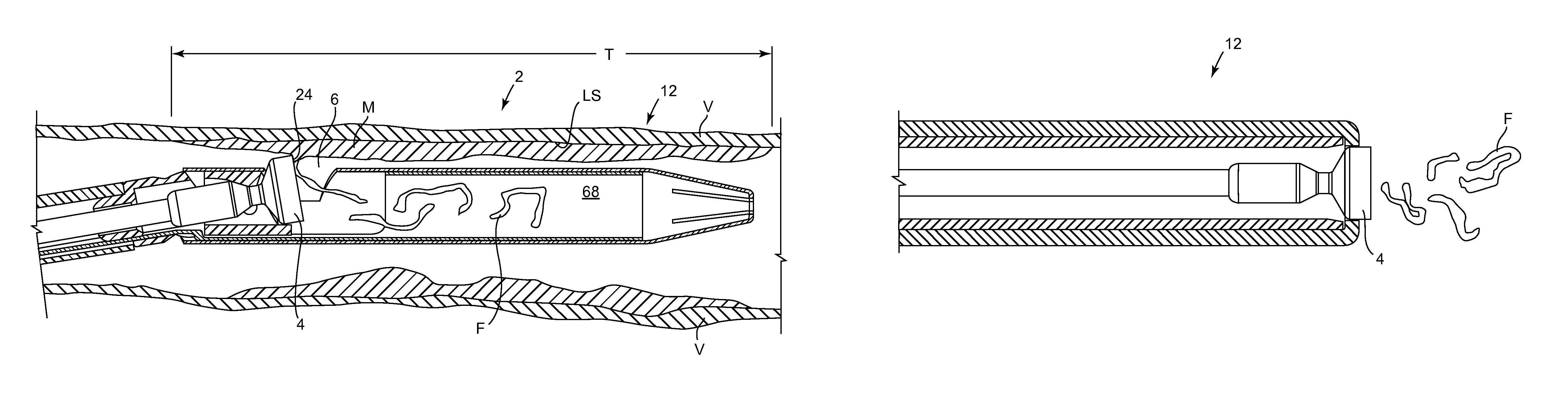 Easily cleaned atherectomy catheters and methods of use