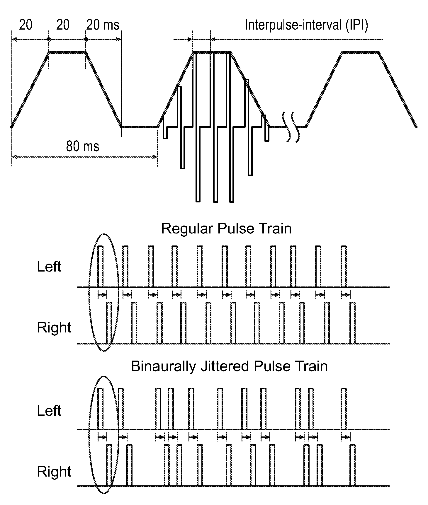 Binaural stimulation in neural auditory prostheses or hearing aids