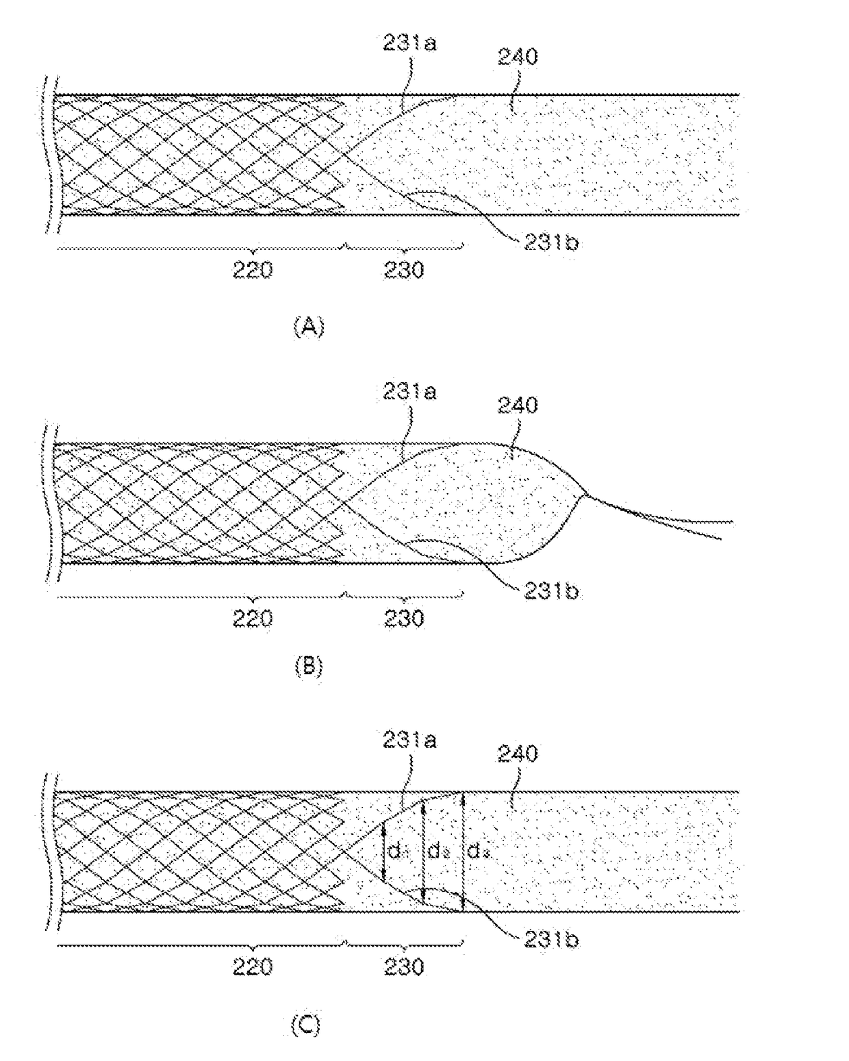 Antireflux stent