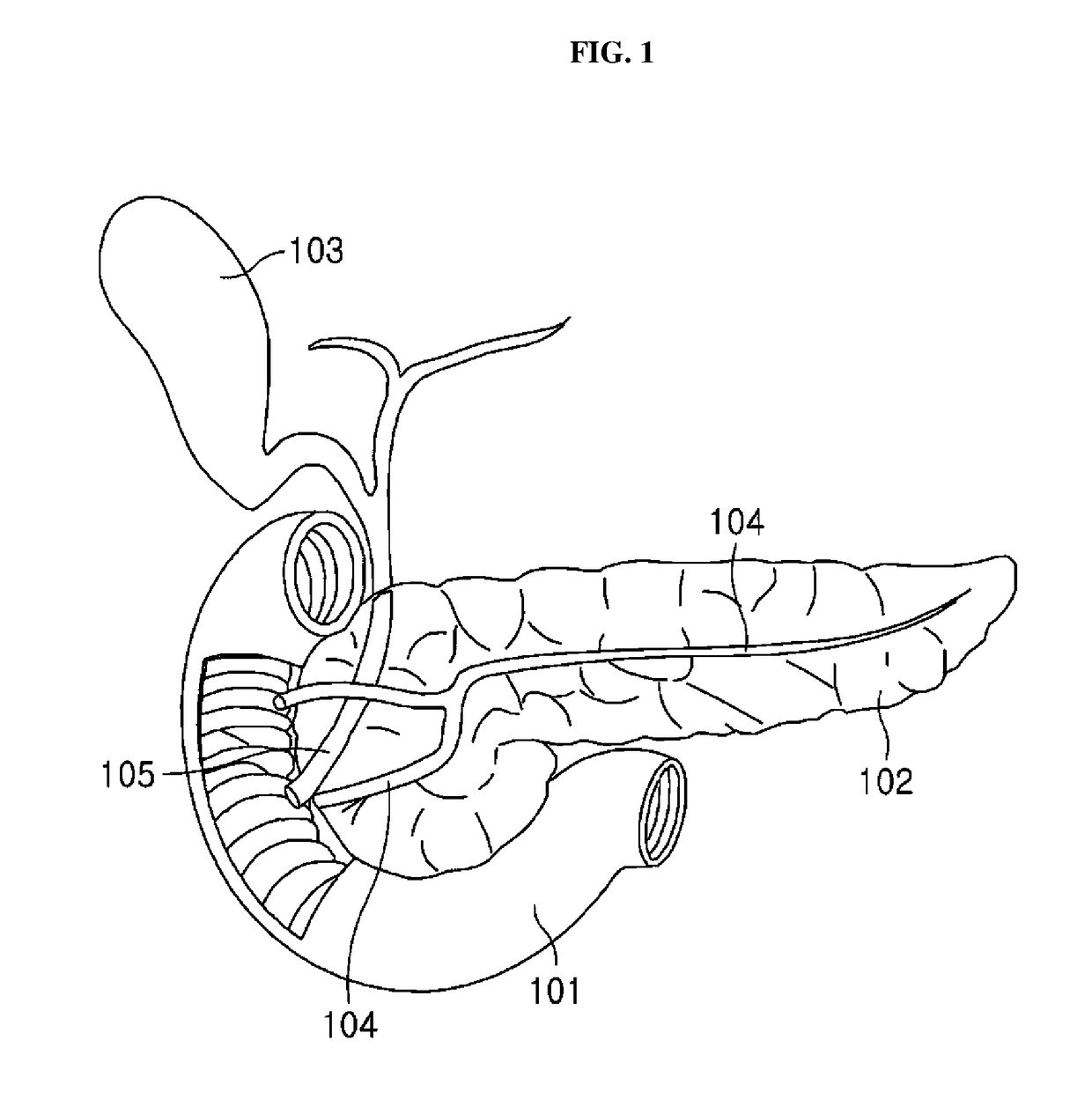 Antireflux stent