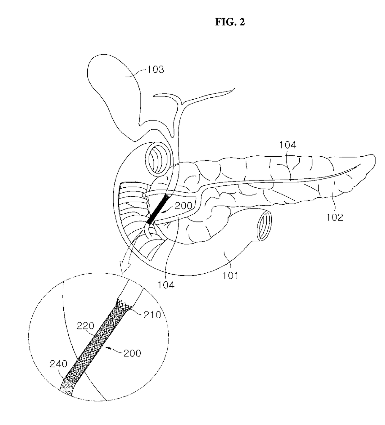 Antireflux stent