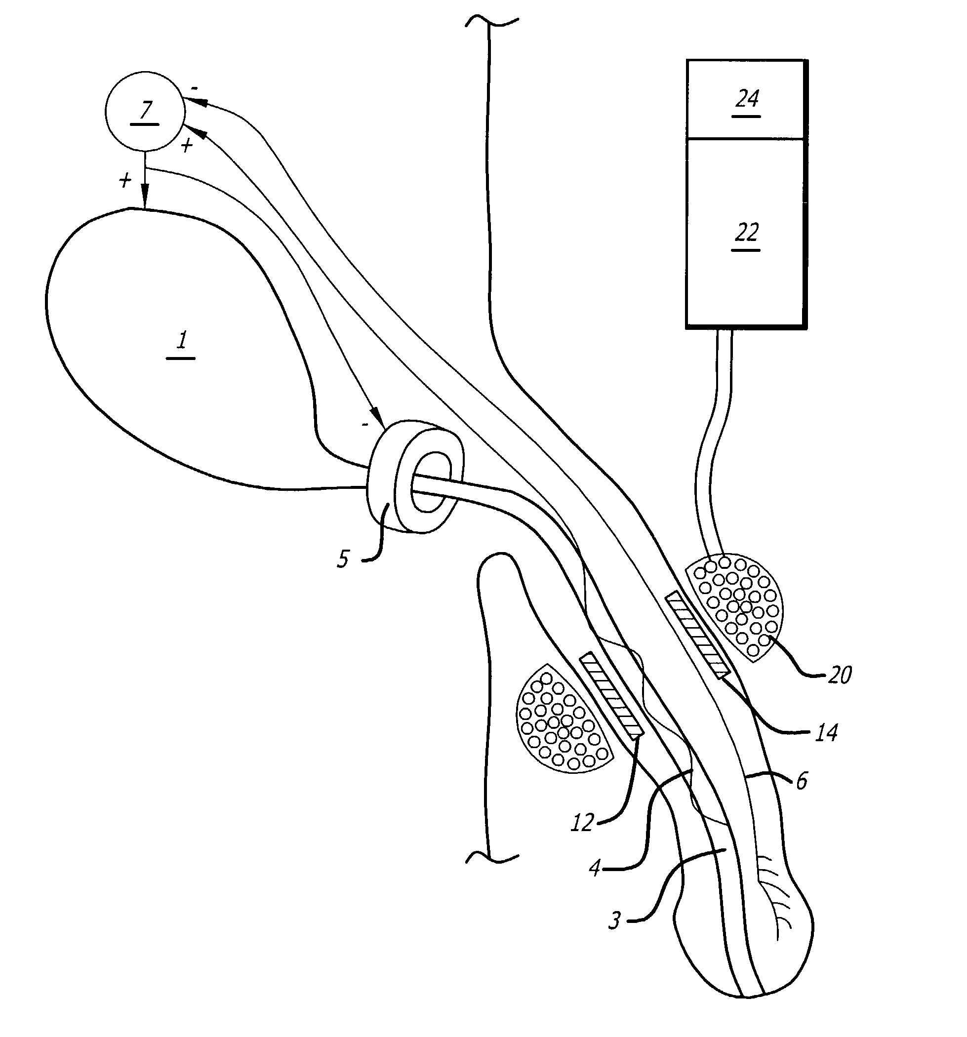 Method and apparatus for the treatment of urinary tract dysfunction