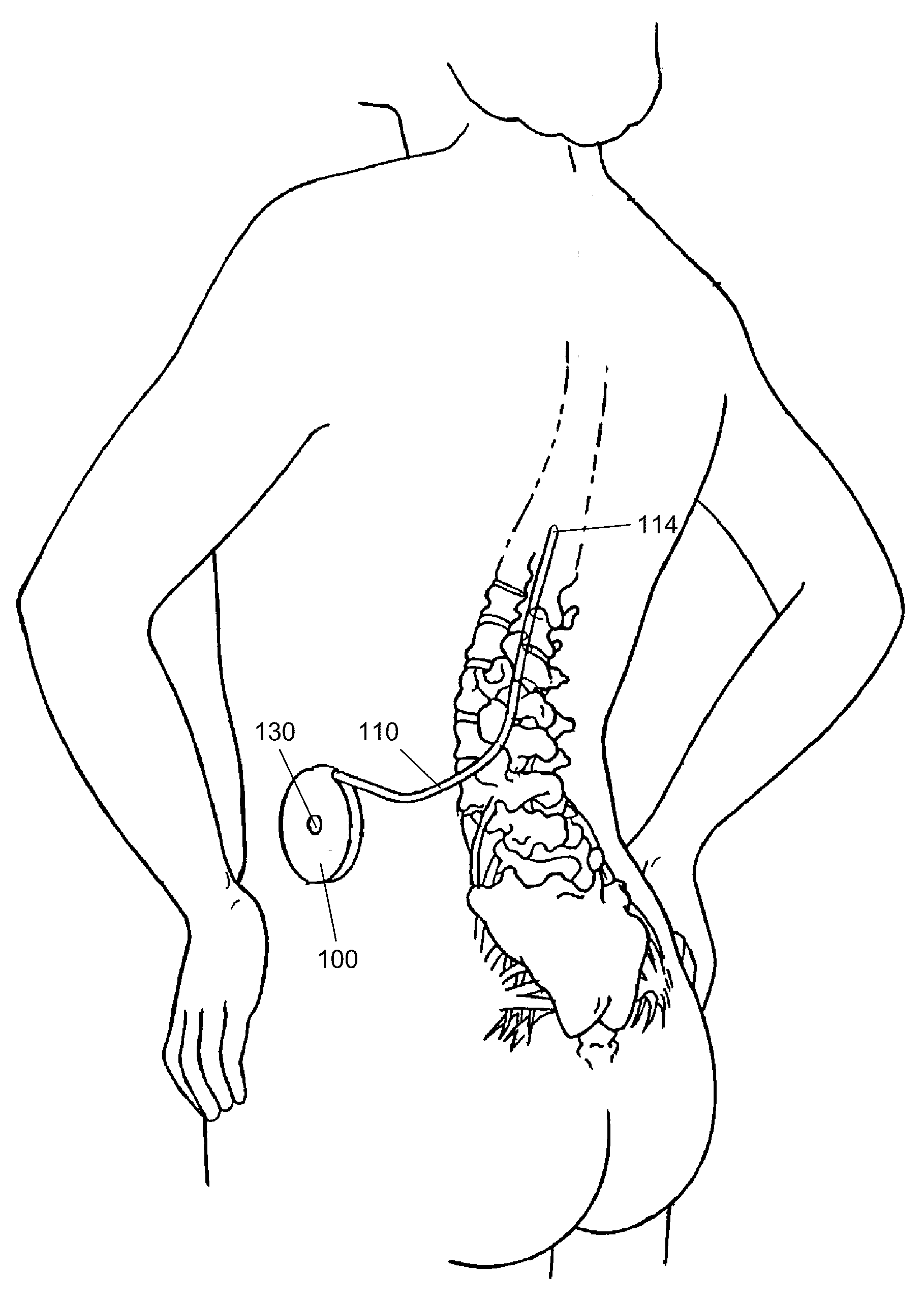 Apheresis of a target molecule from cerebrospinal fluid