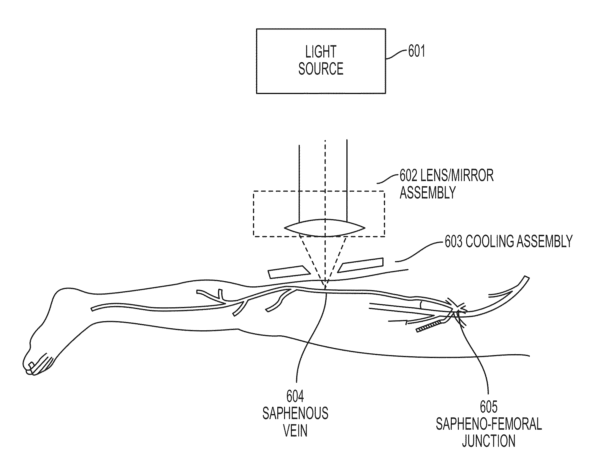 Focused near-infrared lasers for non-invasive varicose veins and other thermal coagulation or occlusion procedures