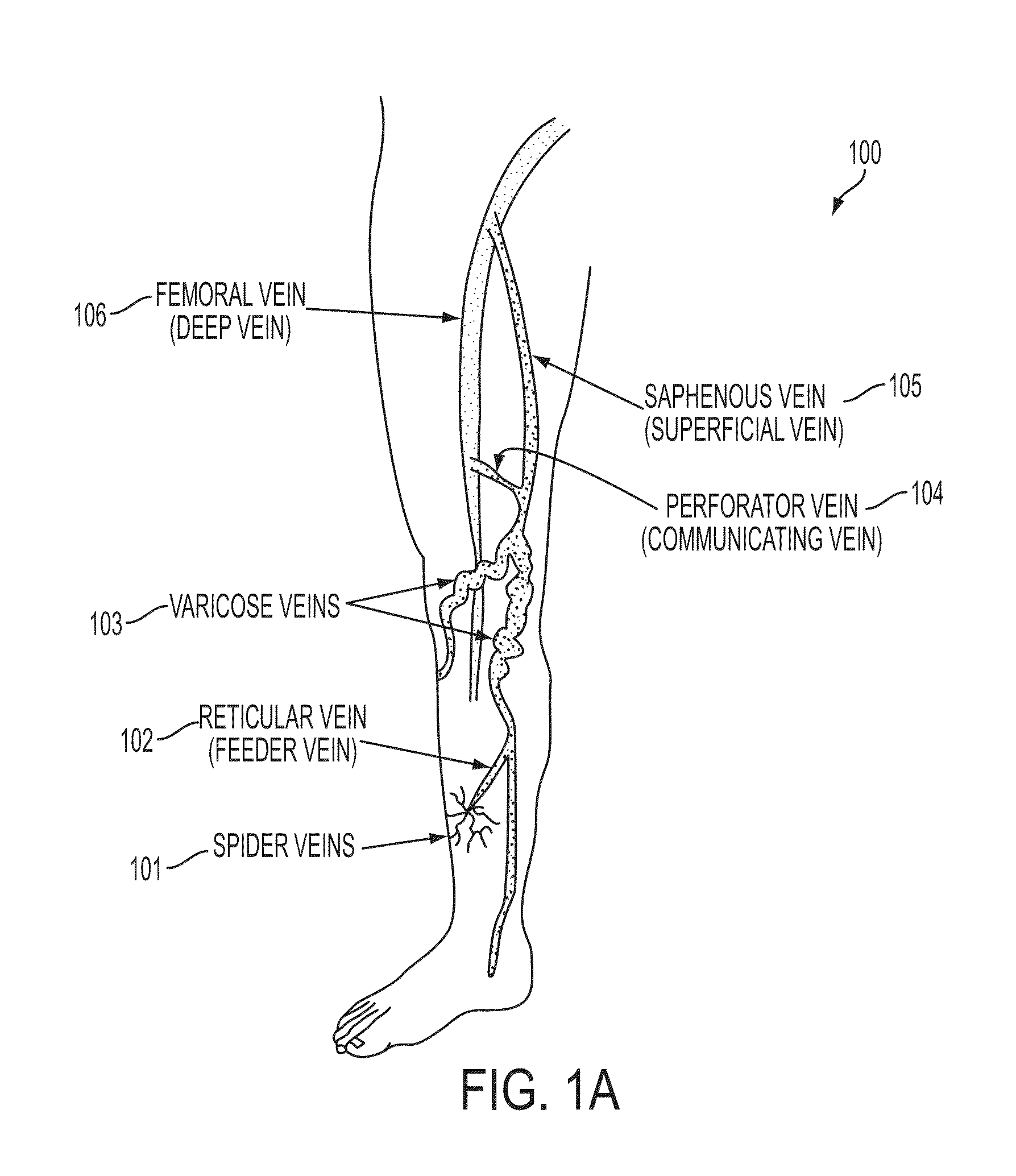 Focused near-infrared lasers for non-invasive varicose veins and other thermal coagulation or occlusion procedures