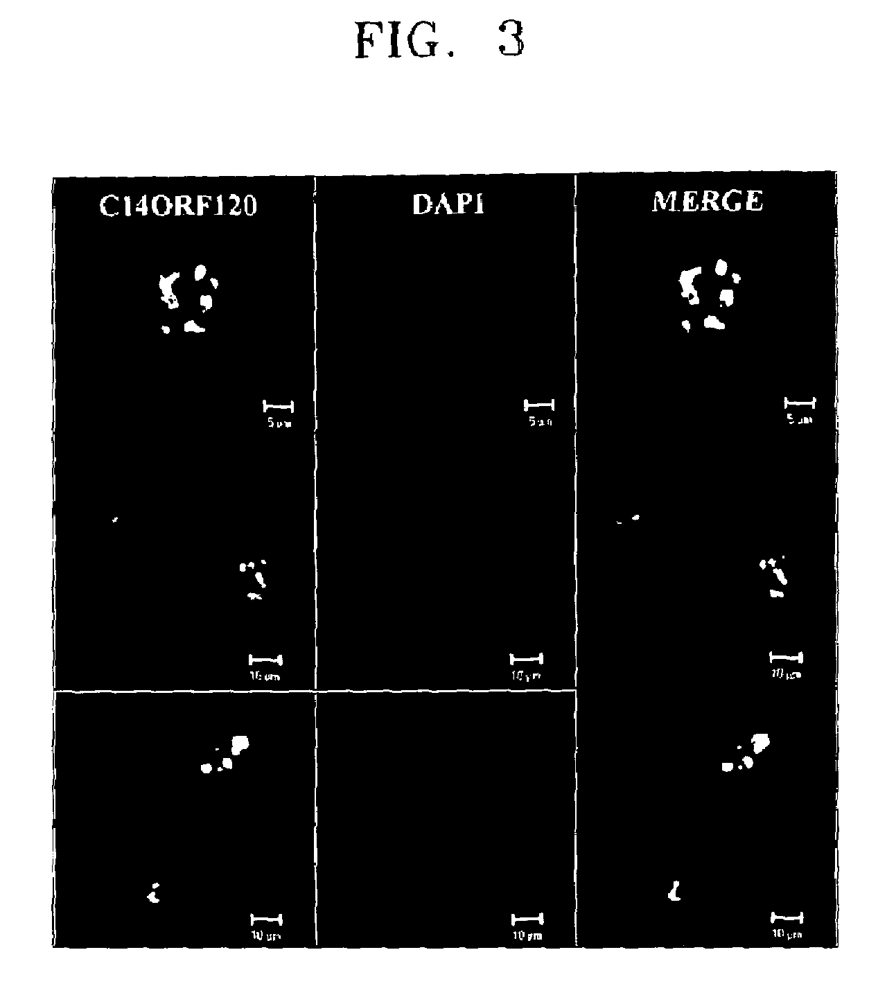 Protein associated with colorectal cancer, polynucleotide including single-nucleotide polymorphism associated with colorectal cancer, microarray and diagnostic kit including the same, and method of diagnosing colorectal cancer using the same