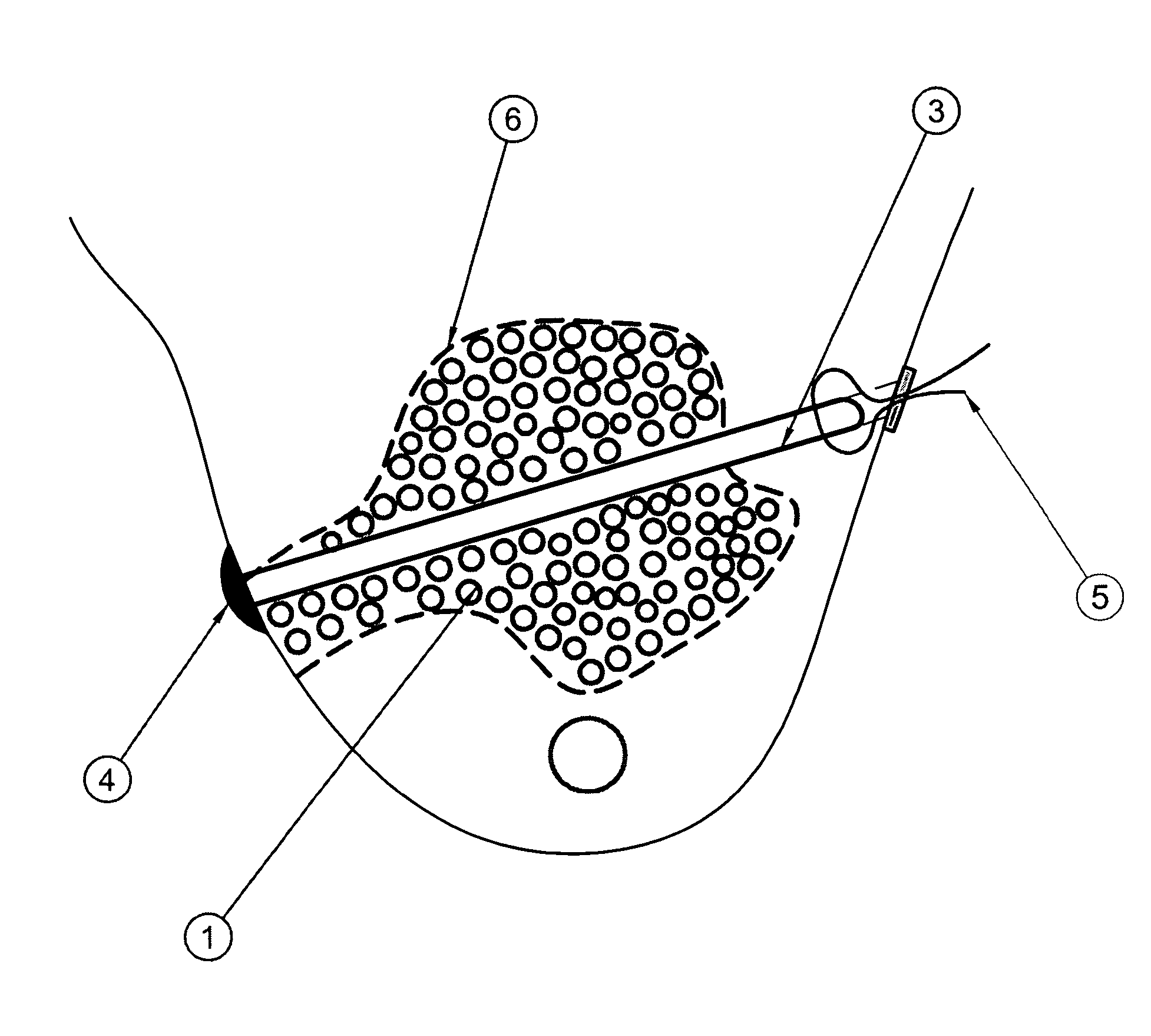 Brachytherapy applicator