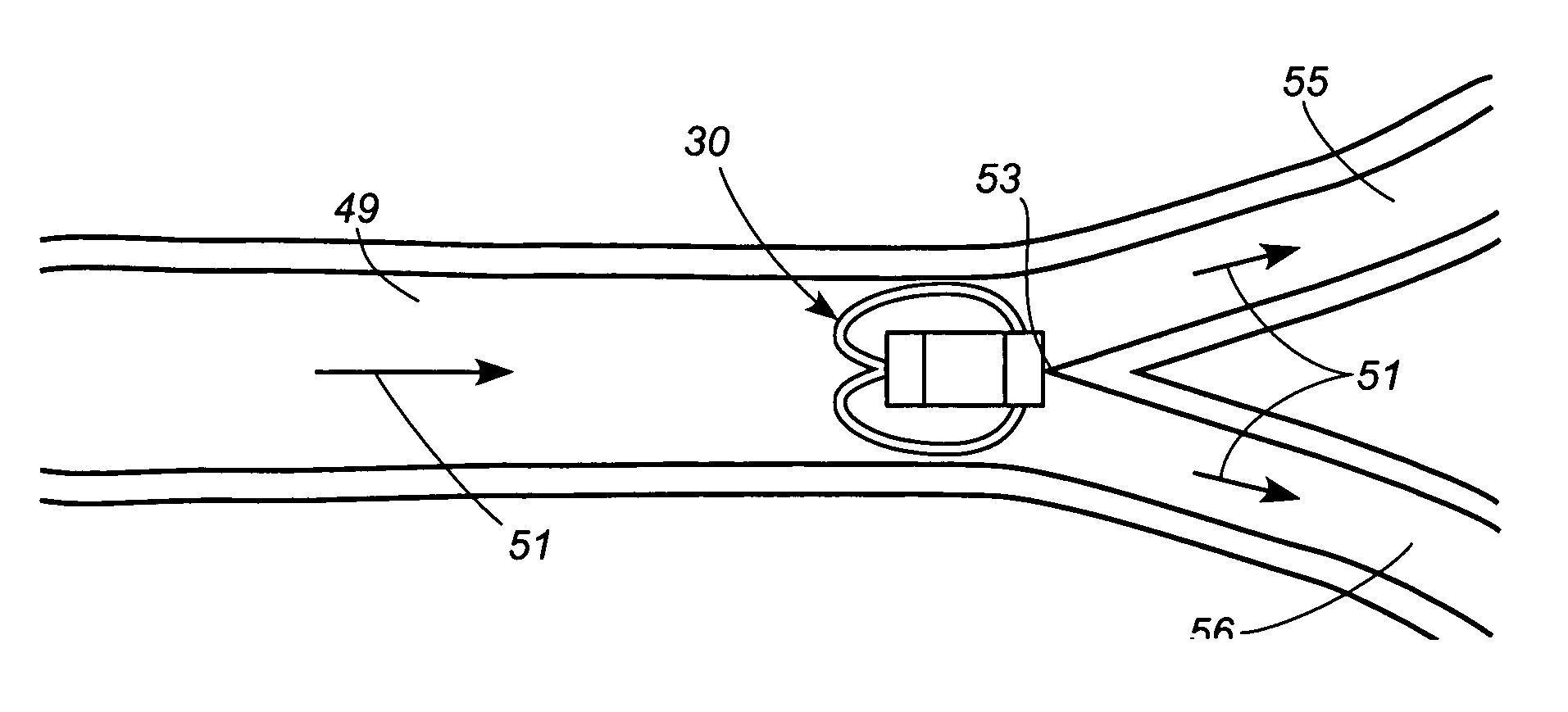 Apparatus and method for sensor deployment and fixation