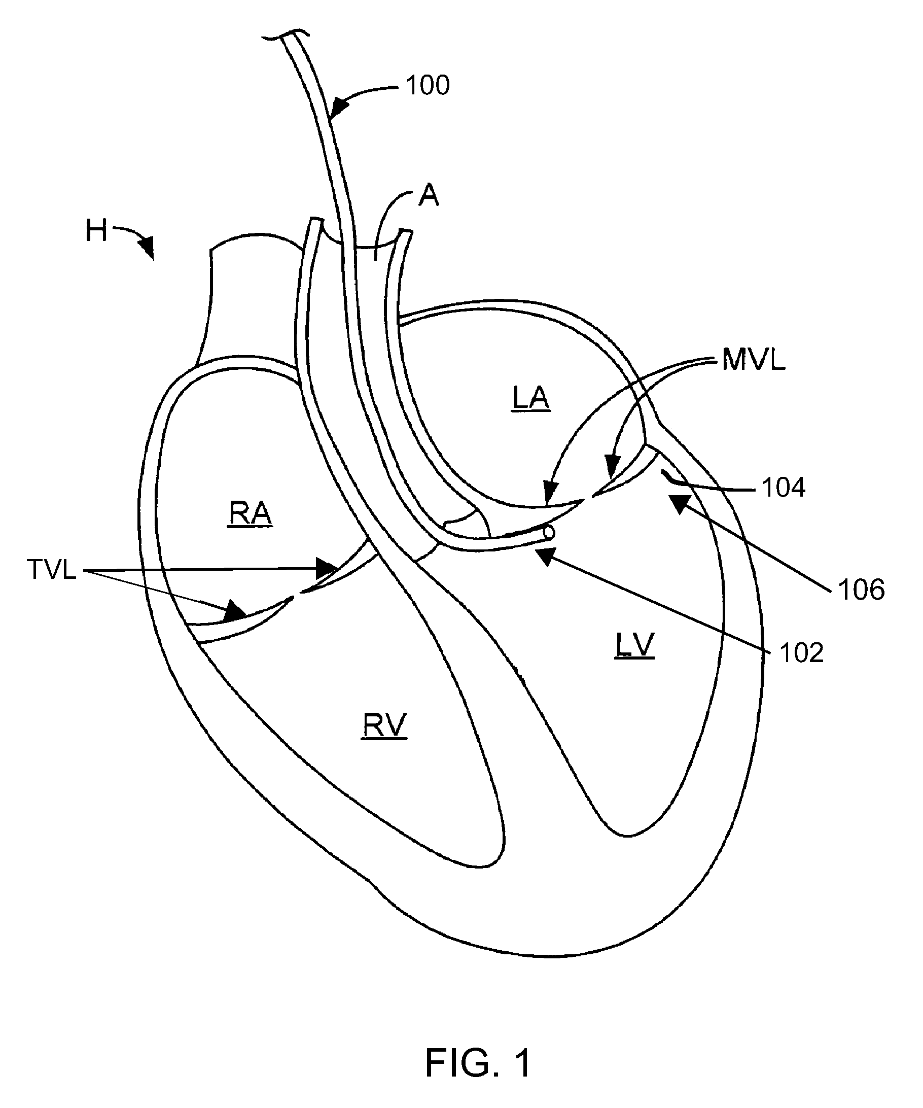 Electrophysiology catheter system