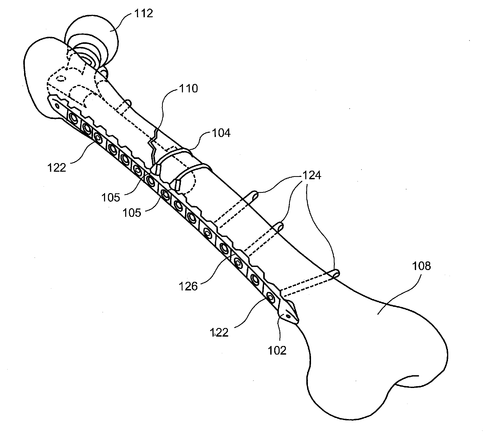 Minimally Invasive Implant and Crimping System