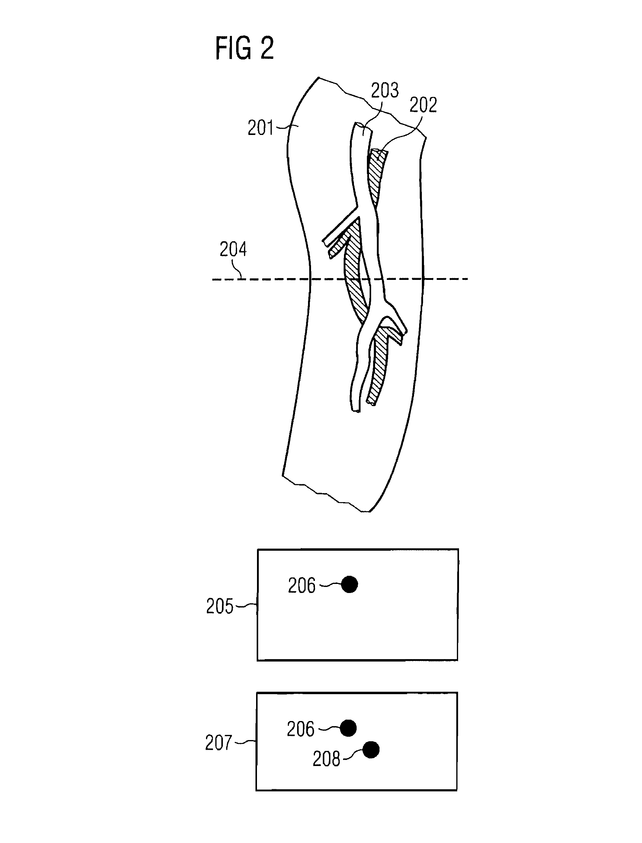 Angiographic method and apparatus allowing identification of contrast agent propagation