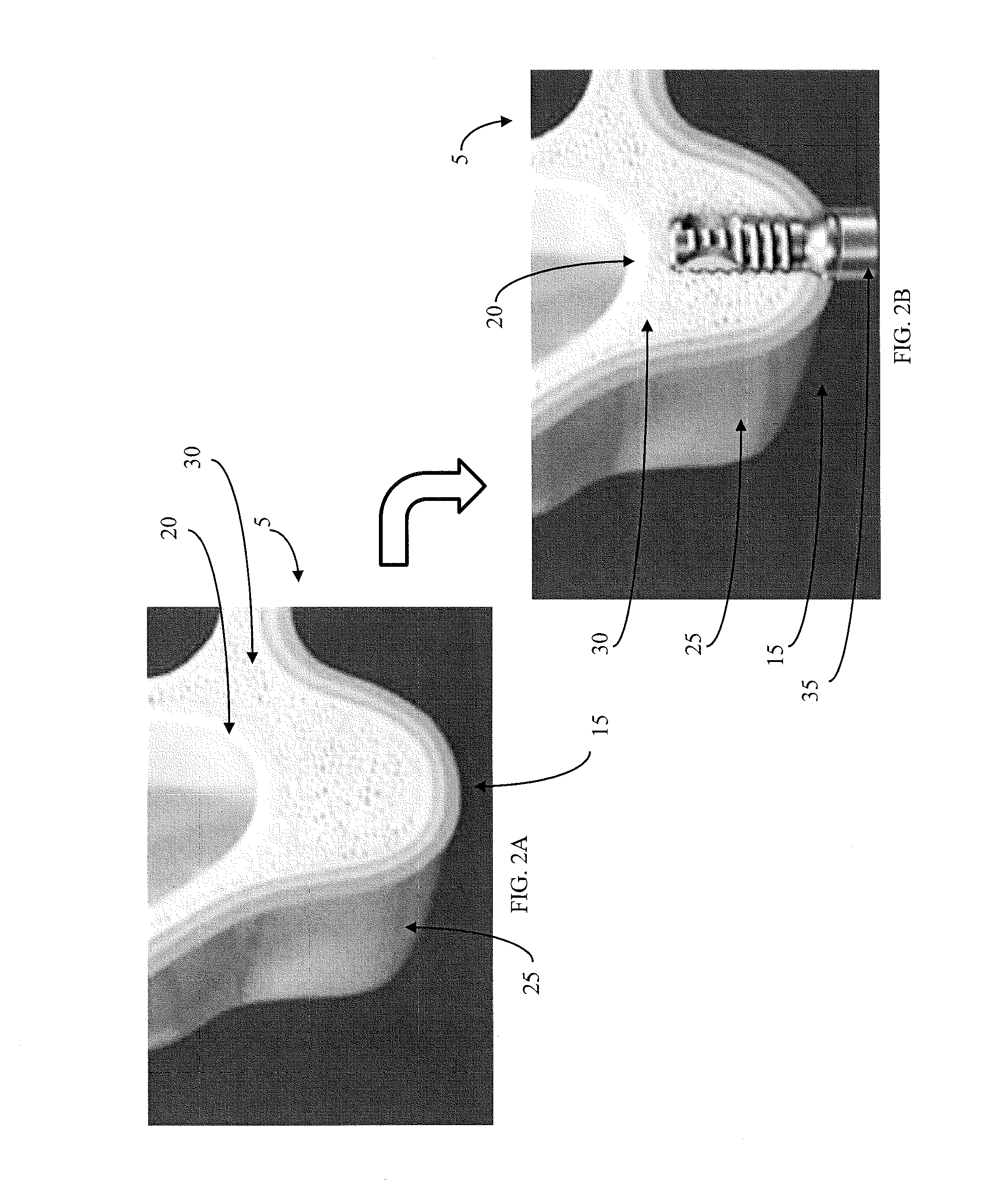 Method for conducting a guided sinus lift procedure