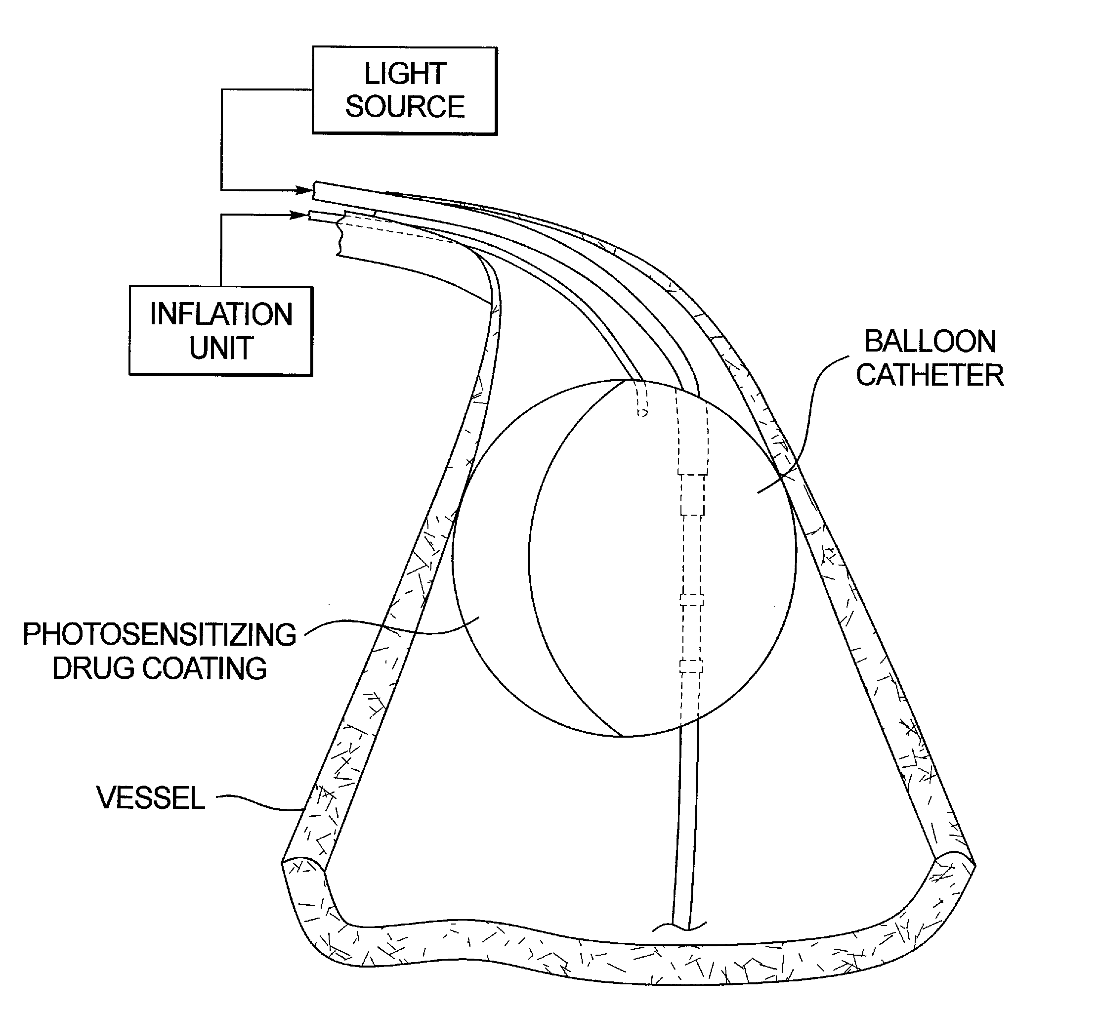 Combined oct catheter device and method for combined optical coherence tomography (OCT) diagnosis and photodynamic therapy (PDT)