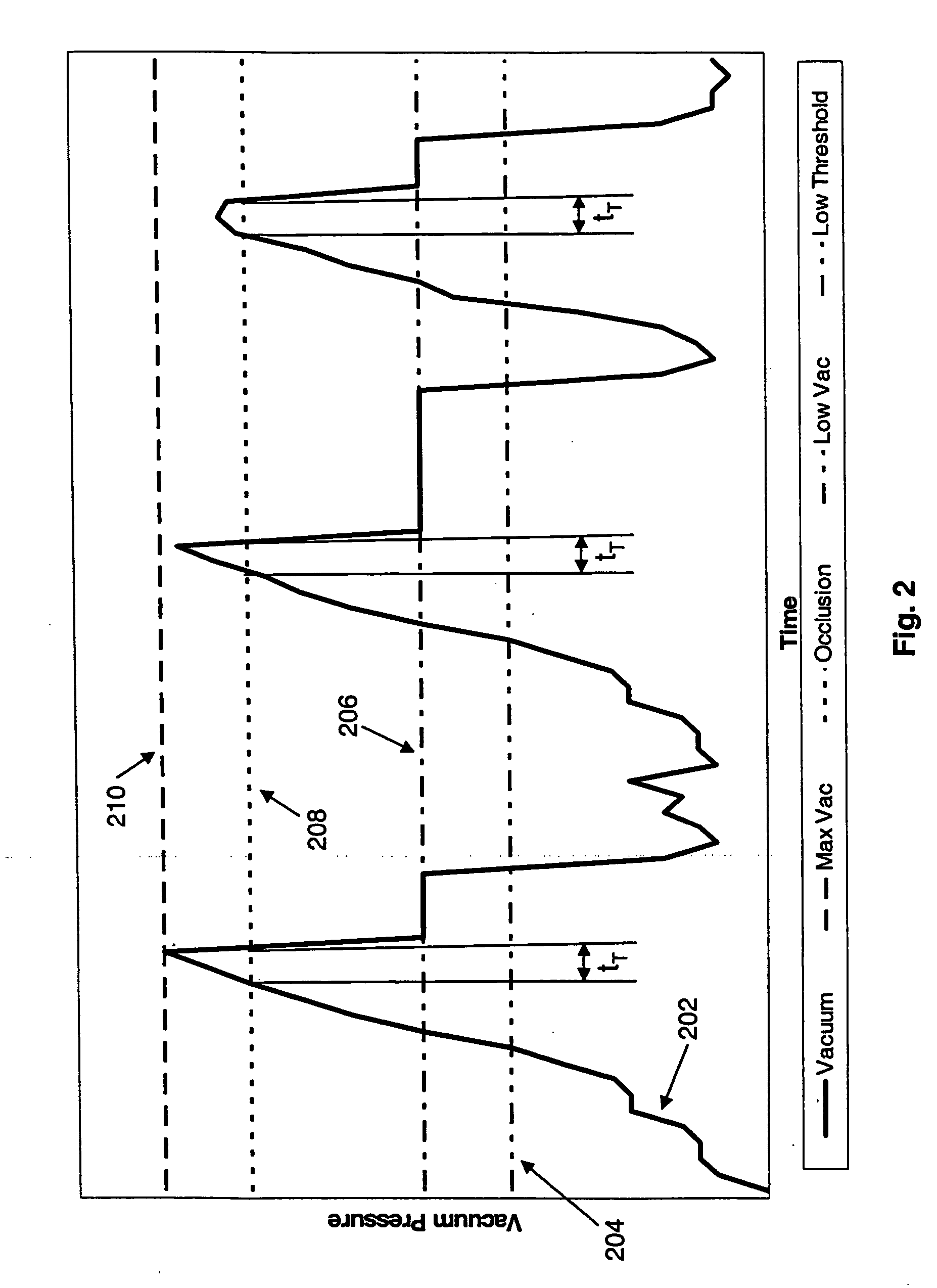 Application of a system parameter as a method and mechanism for controlling eye chamber stability