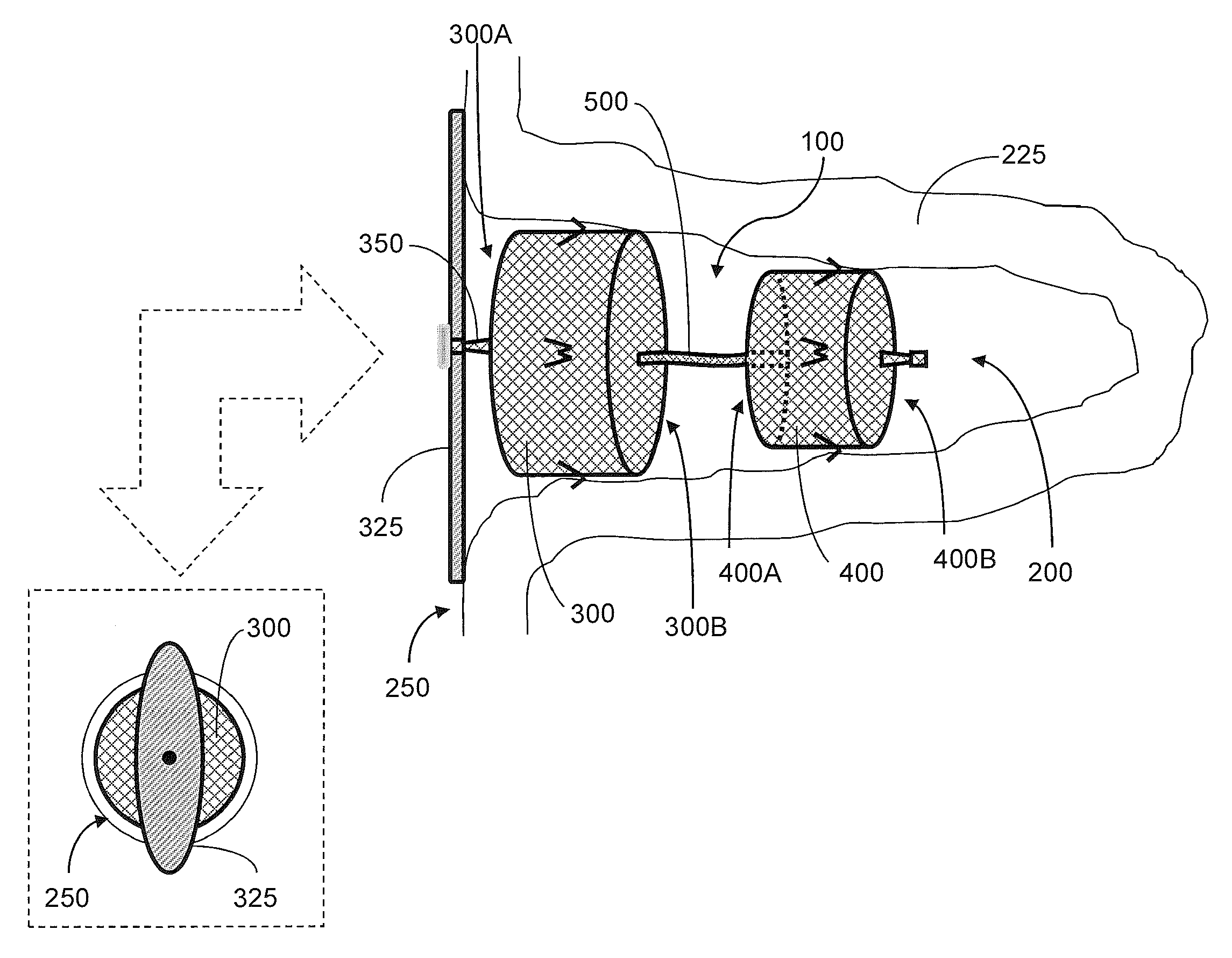 Occlusion device and associated deployment method