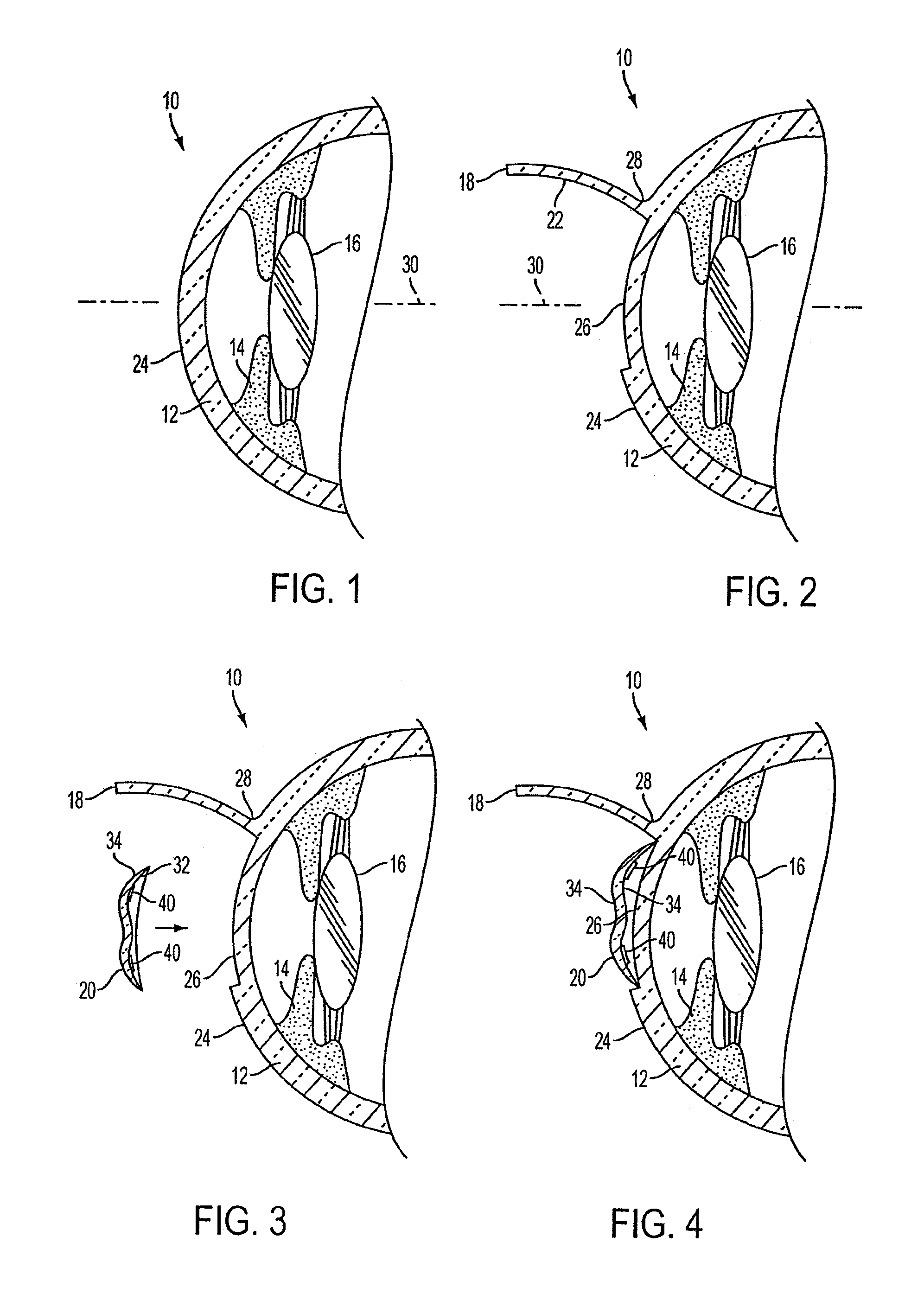 Method of altering the refractive properties of an eye