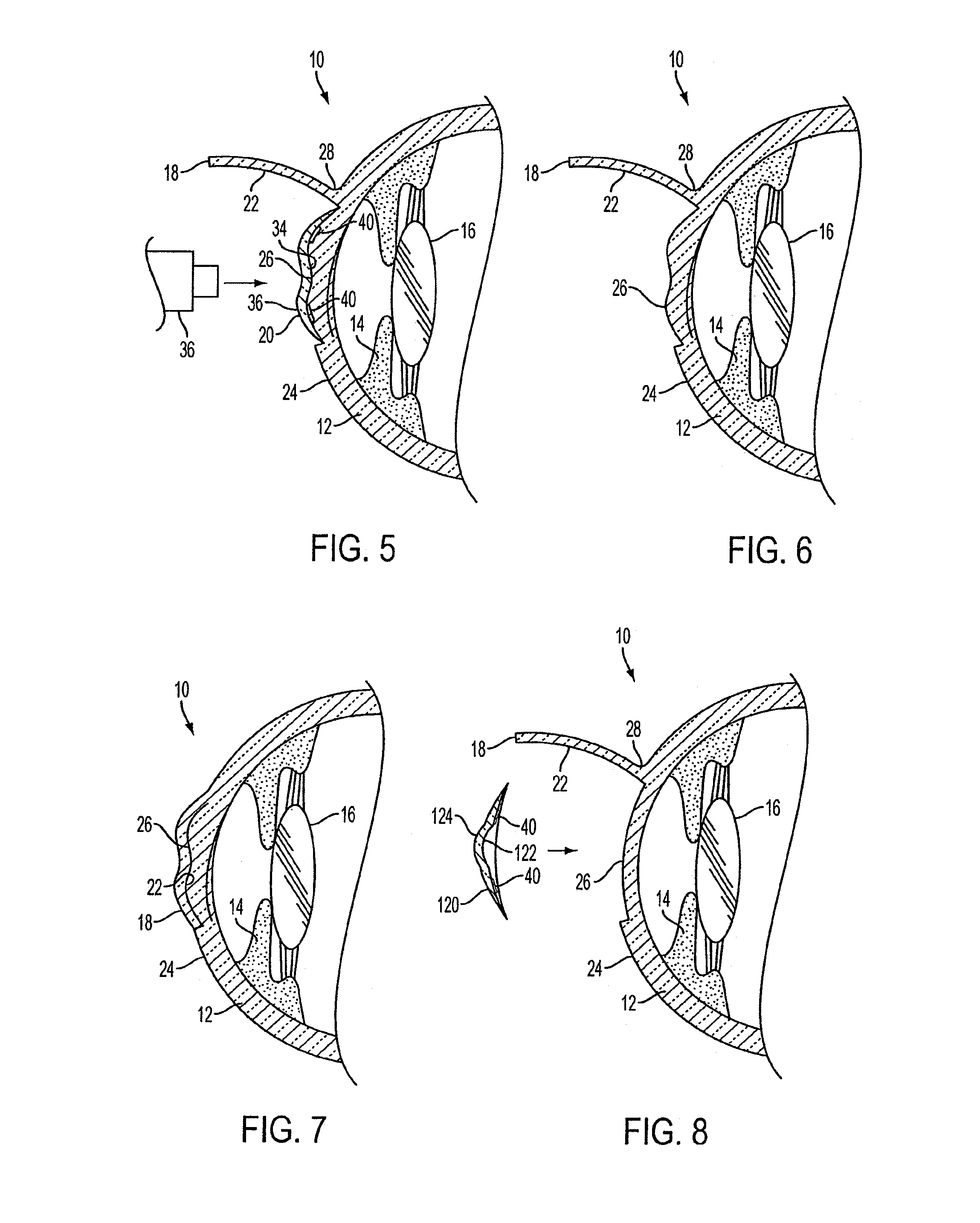 Method of altering the refractive properties of an eye