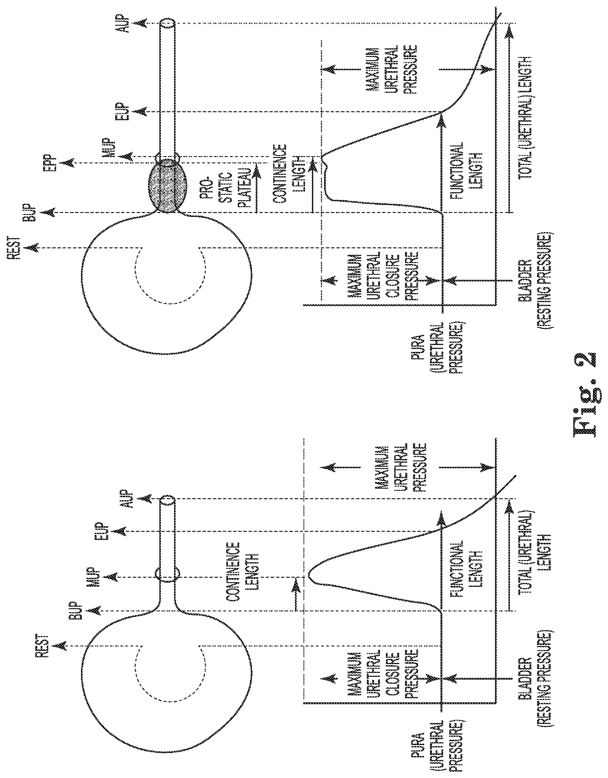 Pressure sensing catheter system