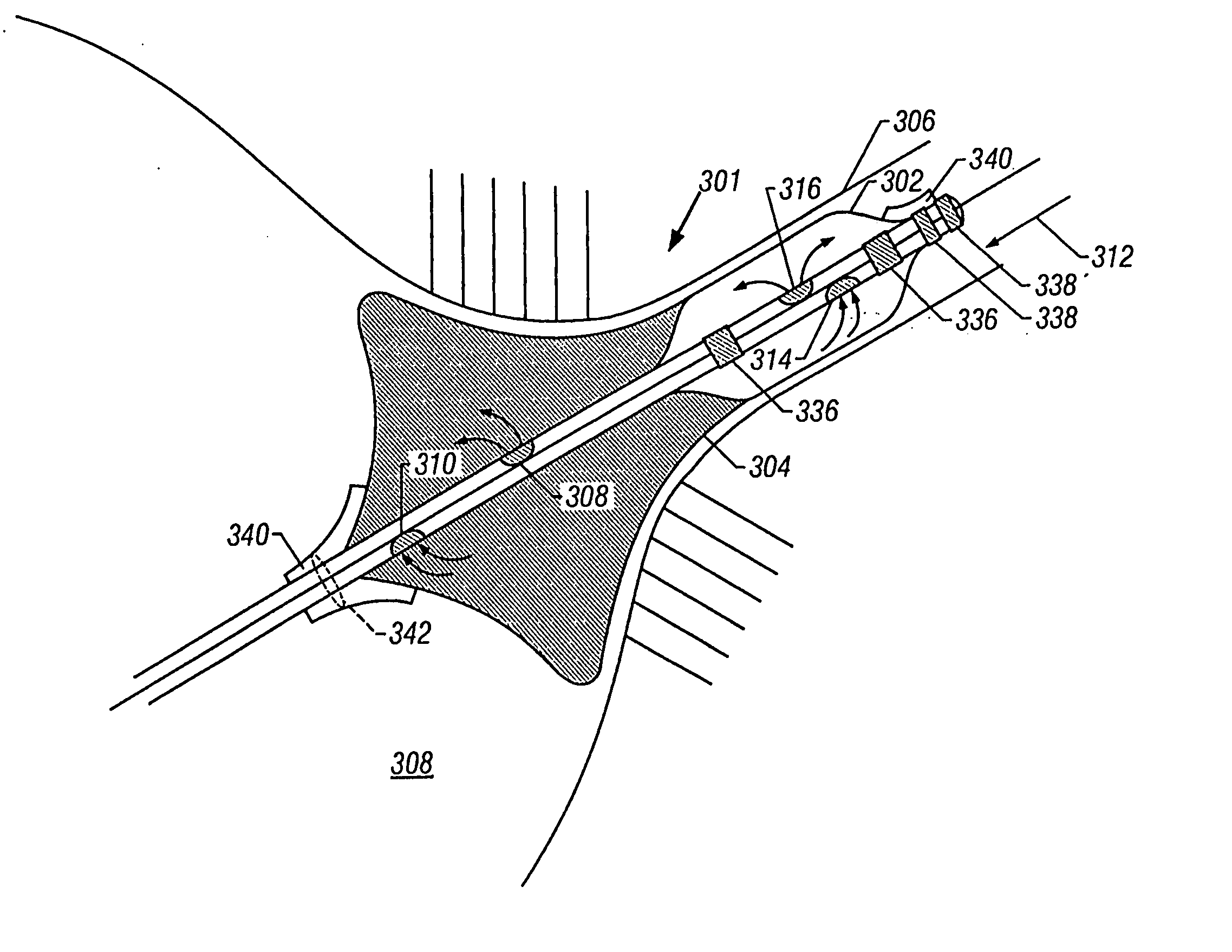 Method and device for performing cooling- or cryo-therapies for, e.g., angioplasty with reduced restenosis or pulmonary vein cell necrosis to inhibit atrial fibrillation employing tissue protection