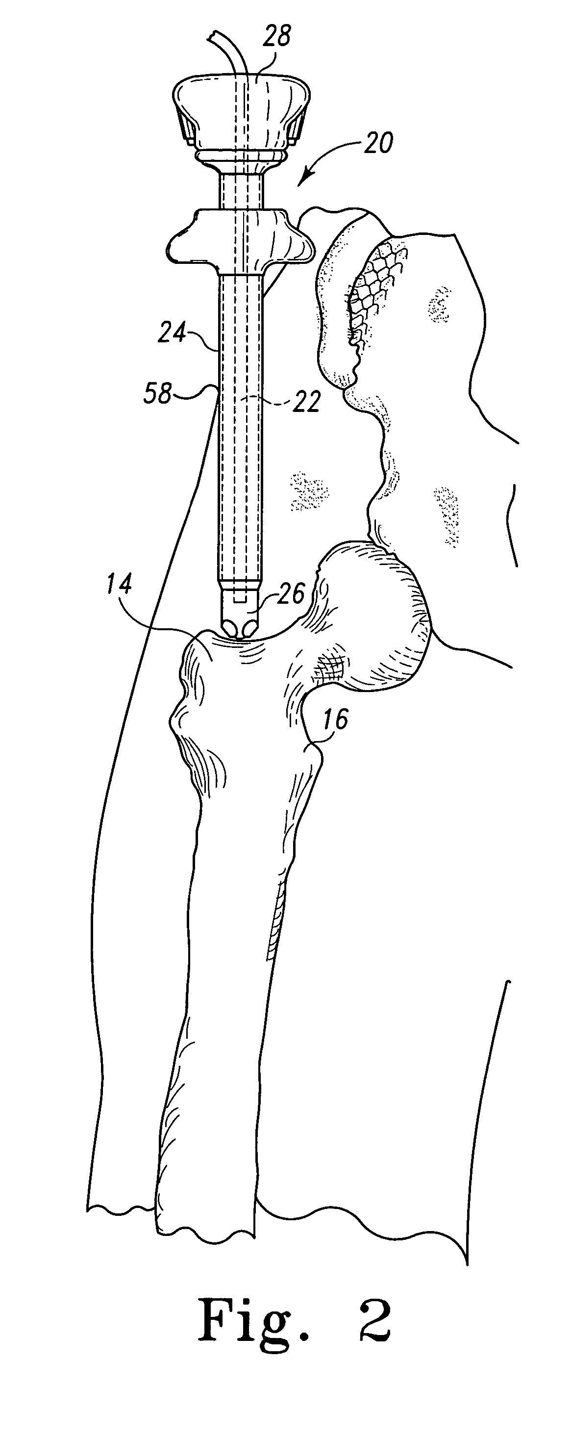 Minimally invasive orthopaedic apparatus and methods