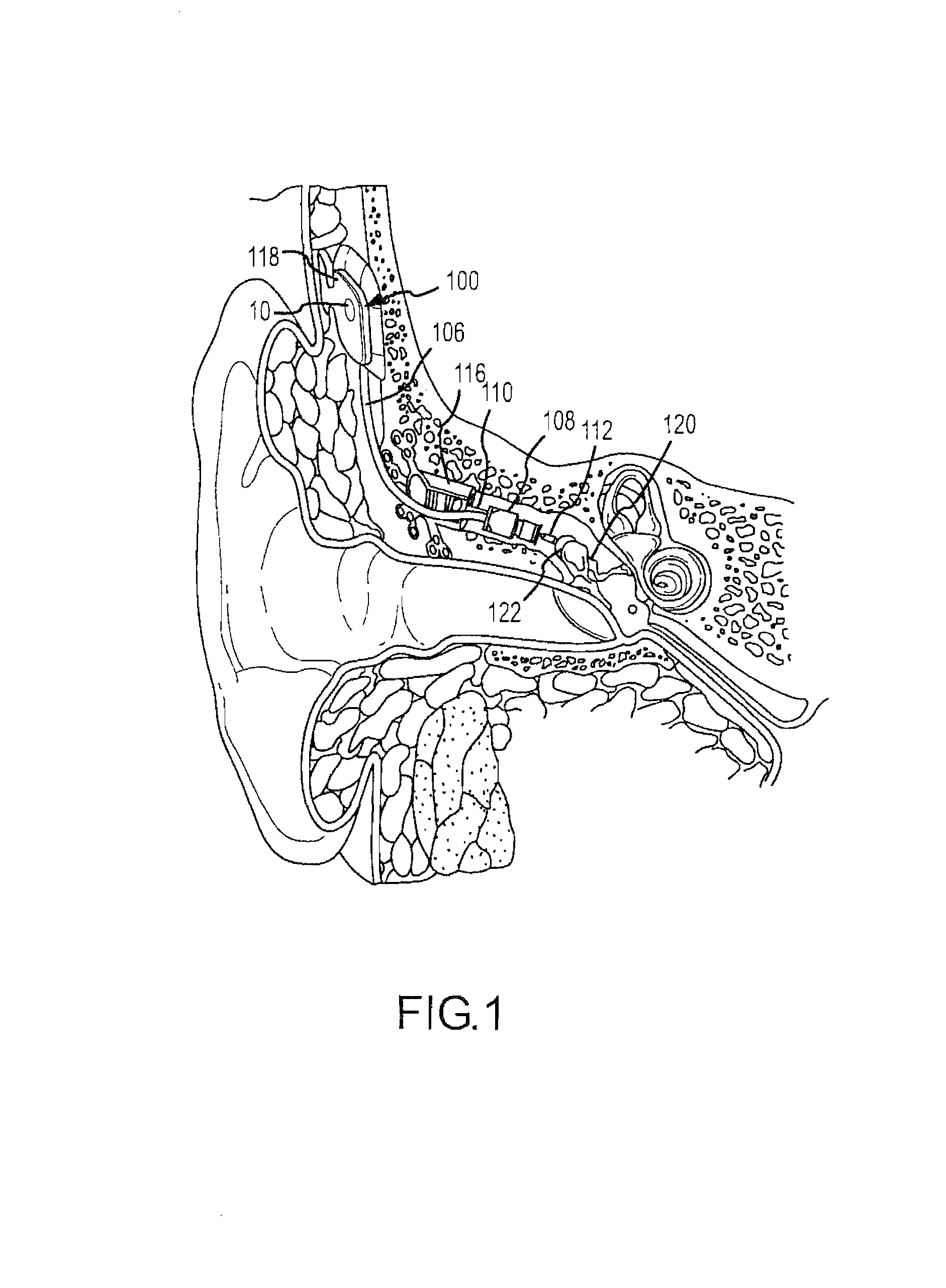 Microphone optimized for implant use