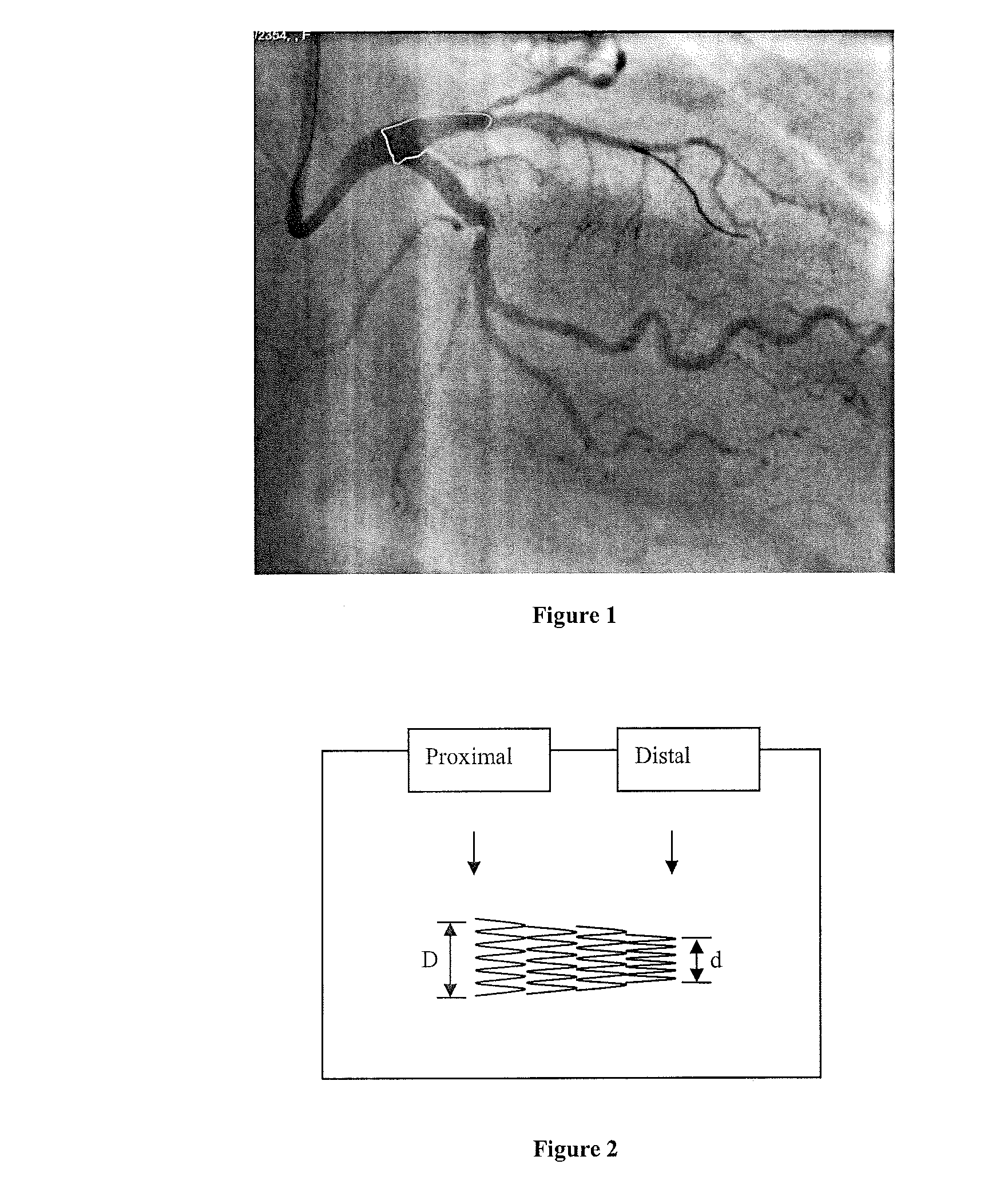 Method of producing personalized biomimetic drug-eluting coronary stents by 3d-printing