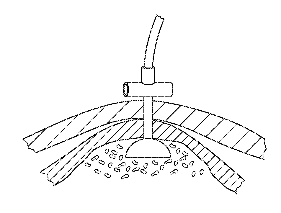 Devices and methods for percutaneous endoscopic gastrostomy and other ostomy procedures