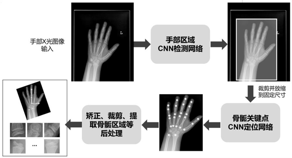 Double-bone-age evaluation method based on joint global and local convolutional neural network features